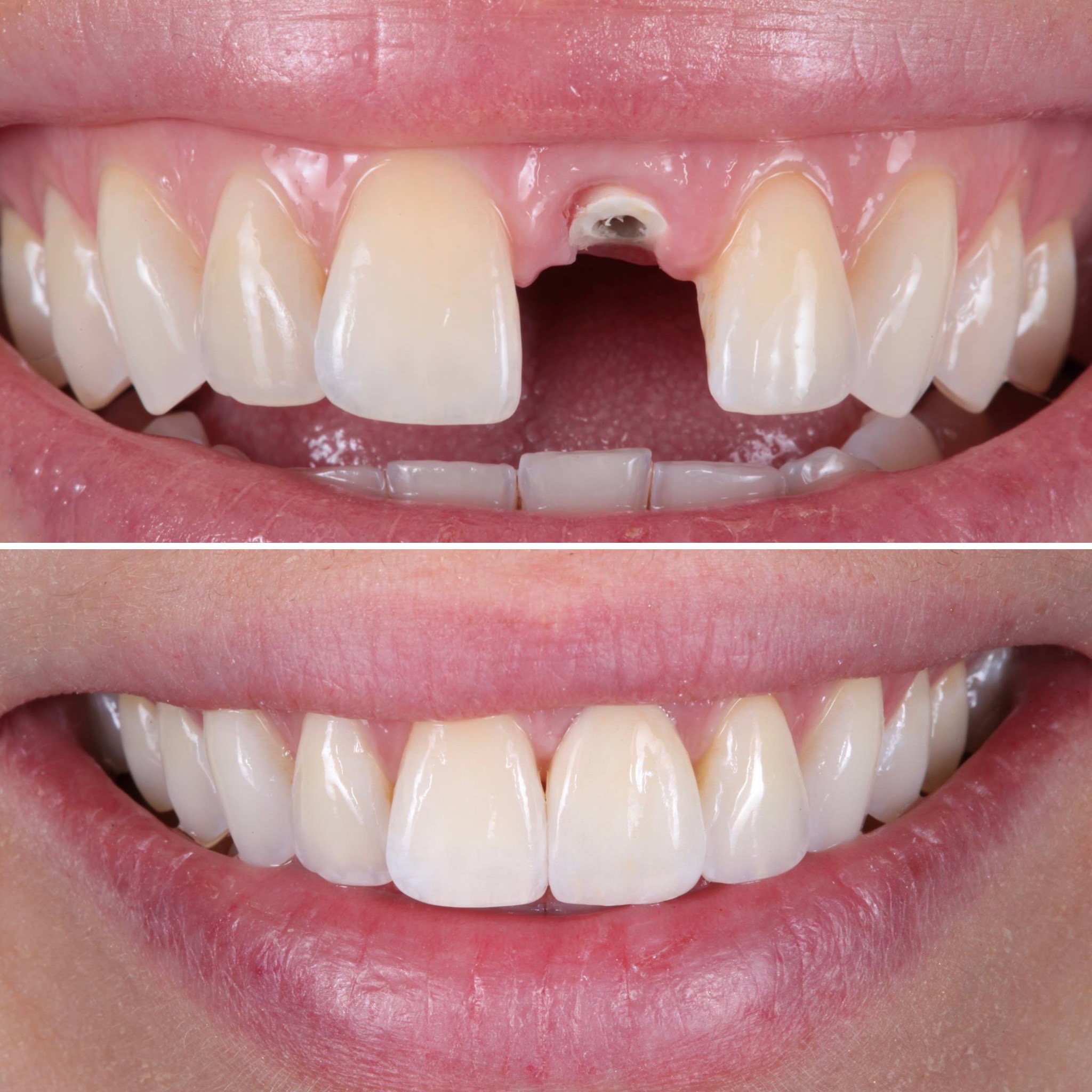 Crown and bridge case — Strupp & Brumm restorative dentistry, Clearwater FL