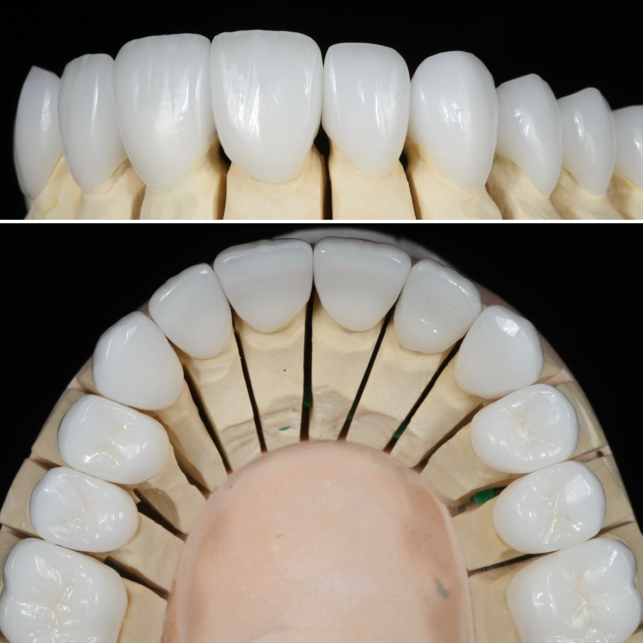Restoration crafted by the Strupp & Brumm in-house dental laboratory