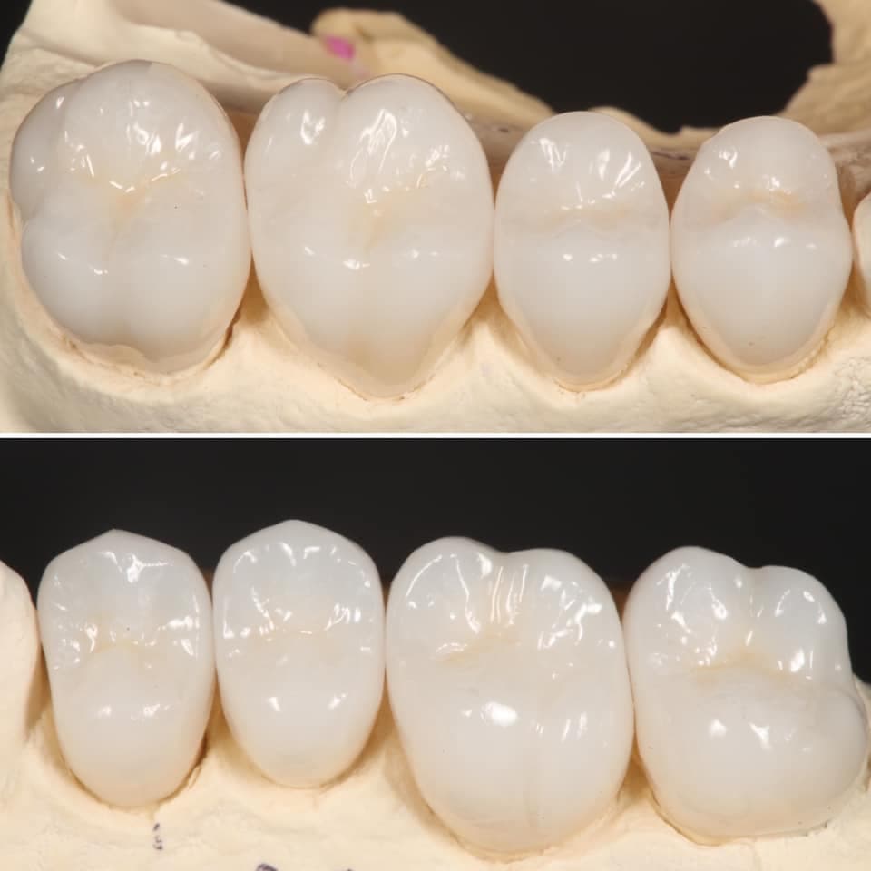 Restoration crafted by Strupp & Brumm in-house dental lab — piece 2
