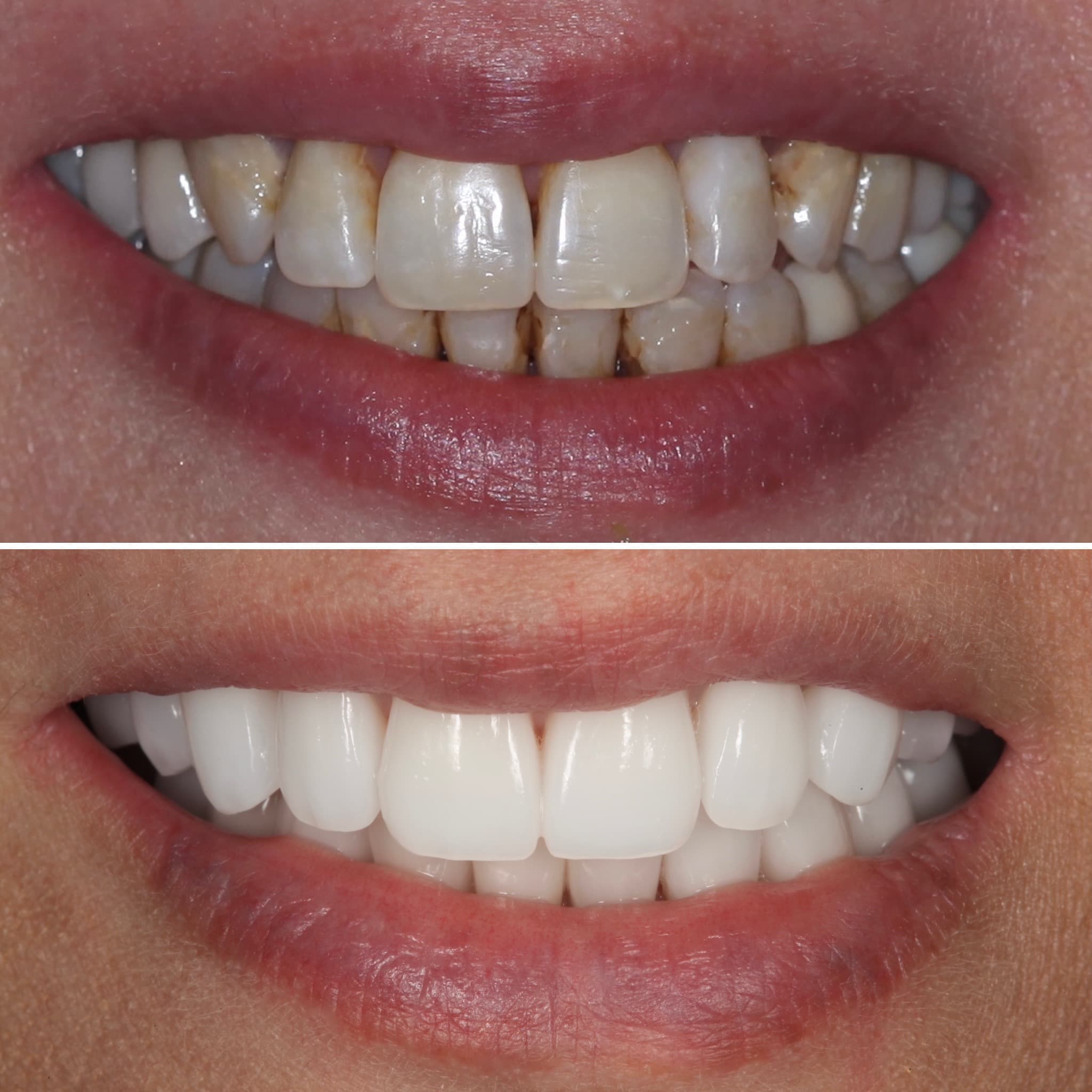 Restoration crafted by Strupp & Brumm in-house dental lab — piece 3