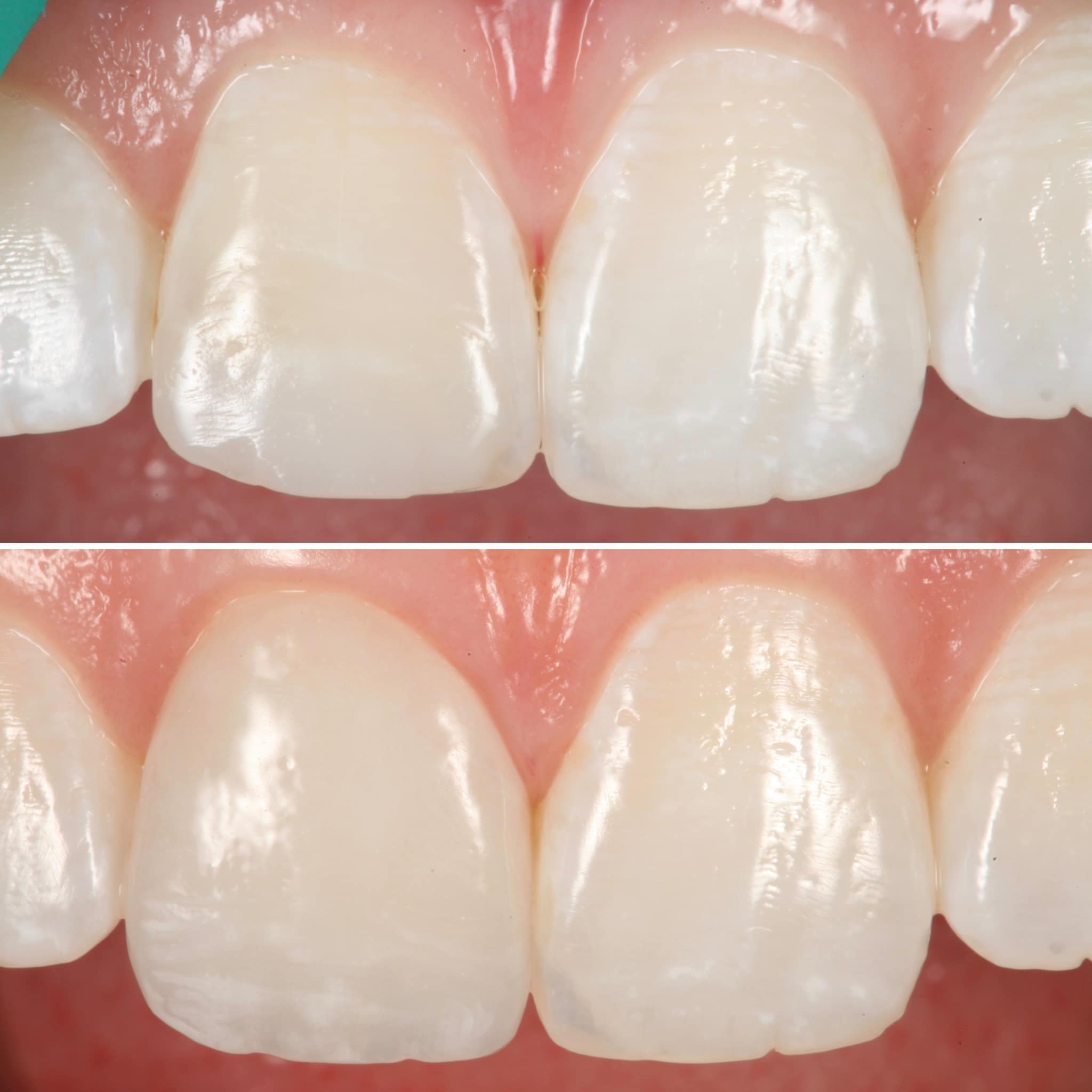 Restoration crafted by Strupp & Brumm in-house dental lab — piece 4