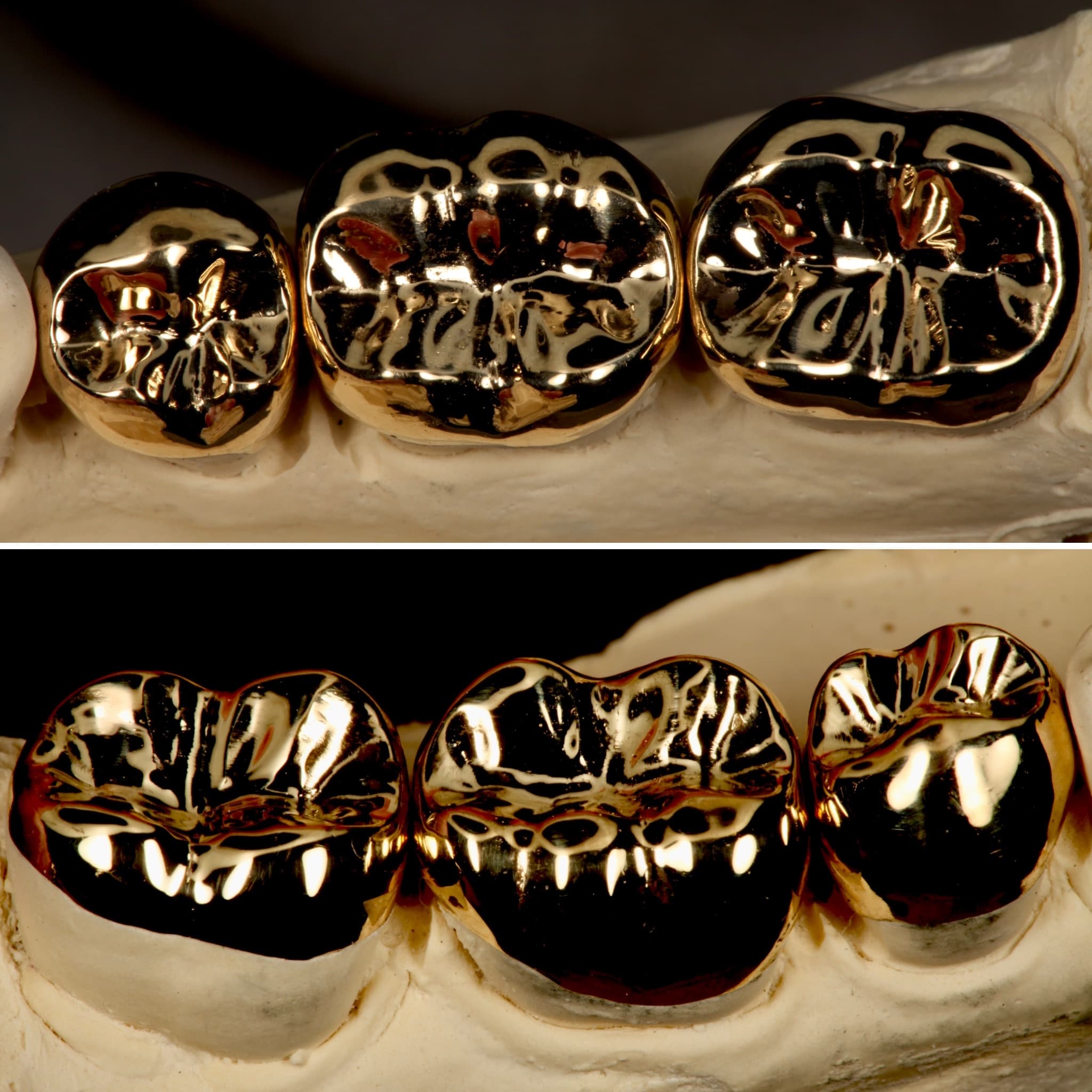 Restoration crafted by Strupp & Brumm in-house dental lab — piece 5