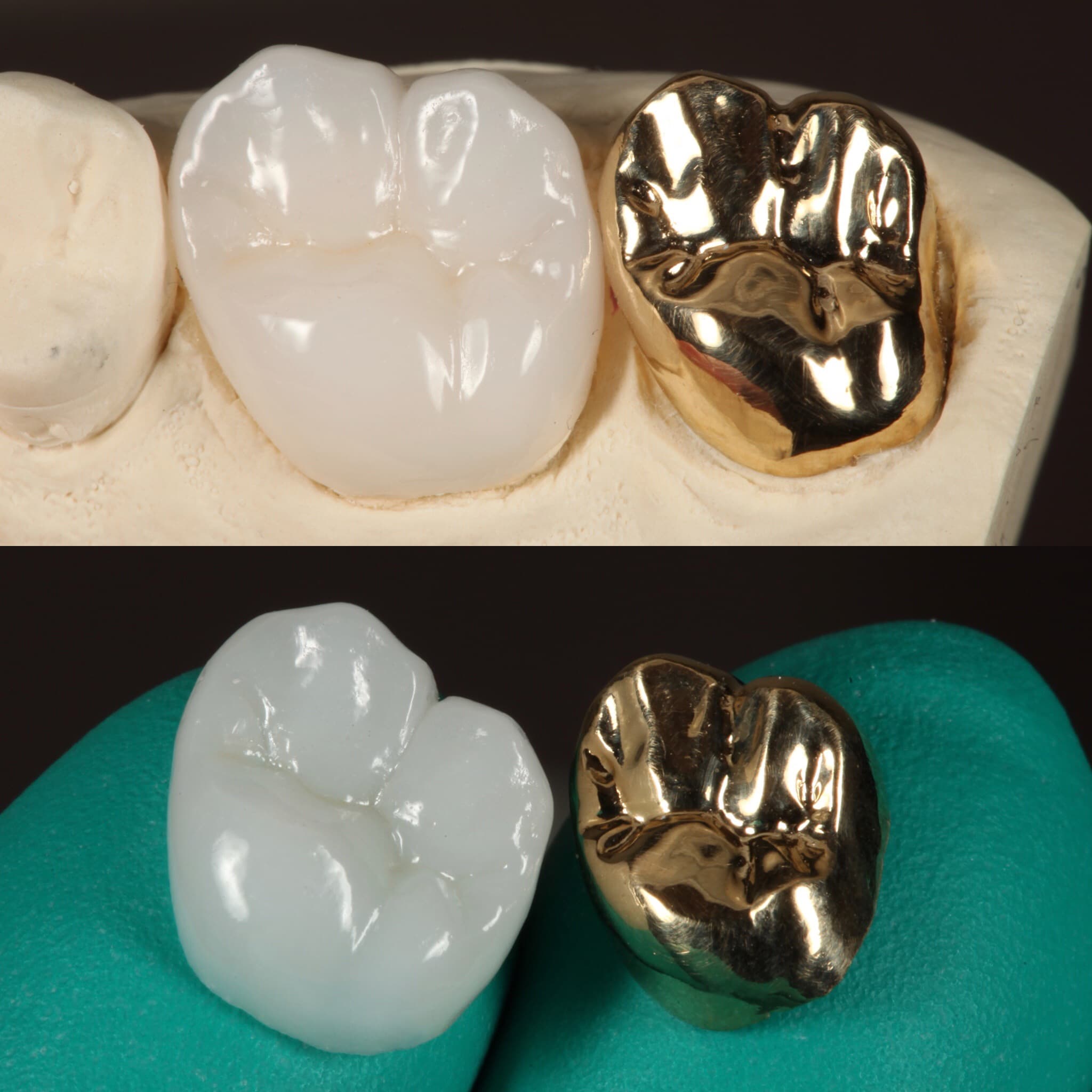 Restoration crafted by Strupp & Brumm in-house dental lab — piece 6