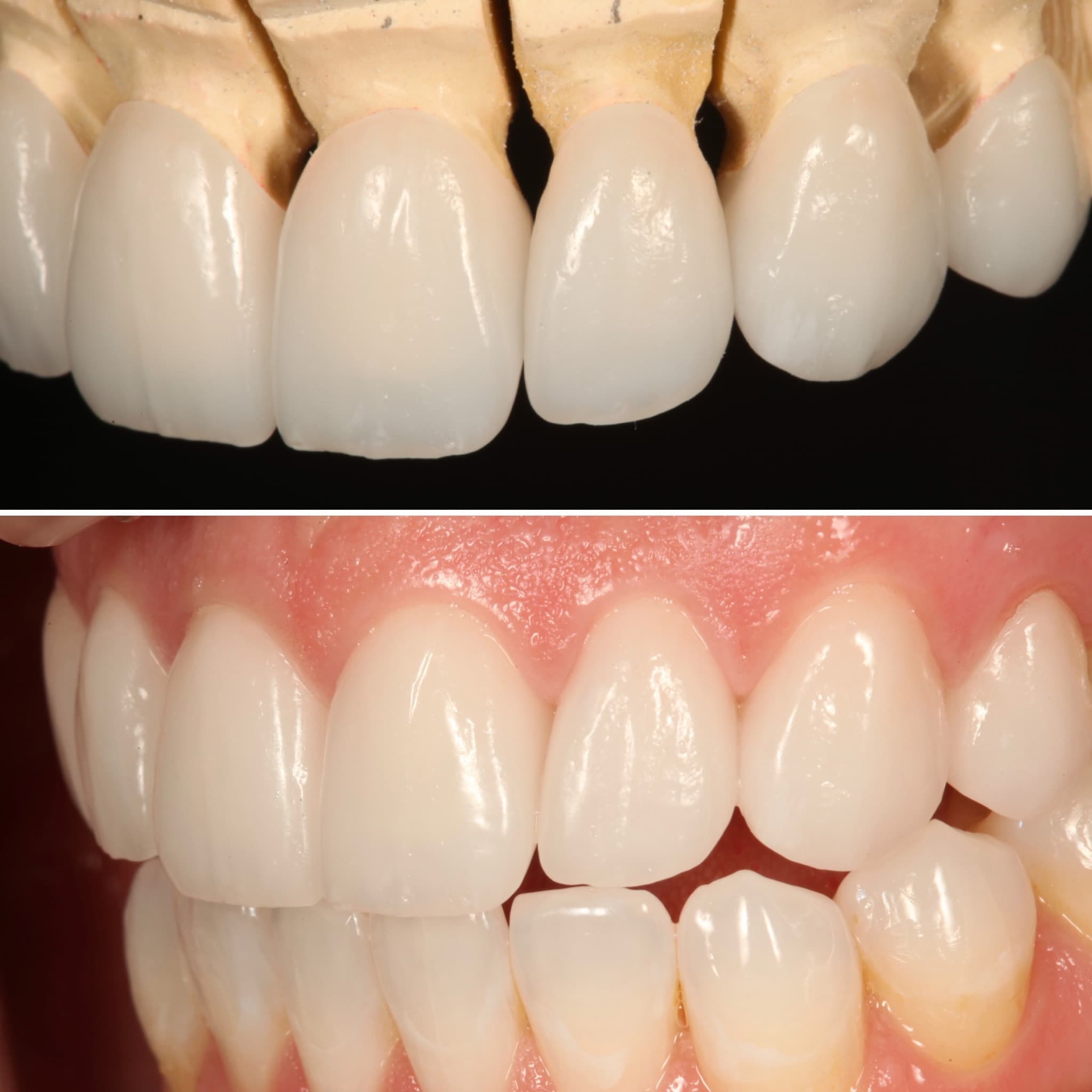 Restoration crafted by Strupp & Brumm in-house dental lab — piece 7