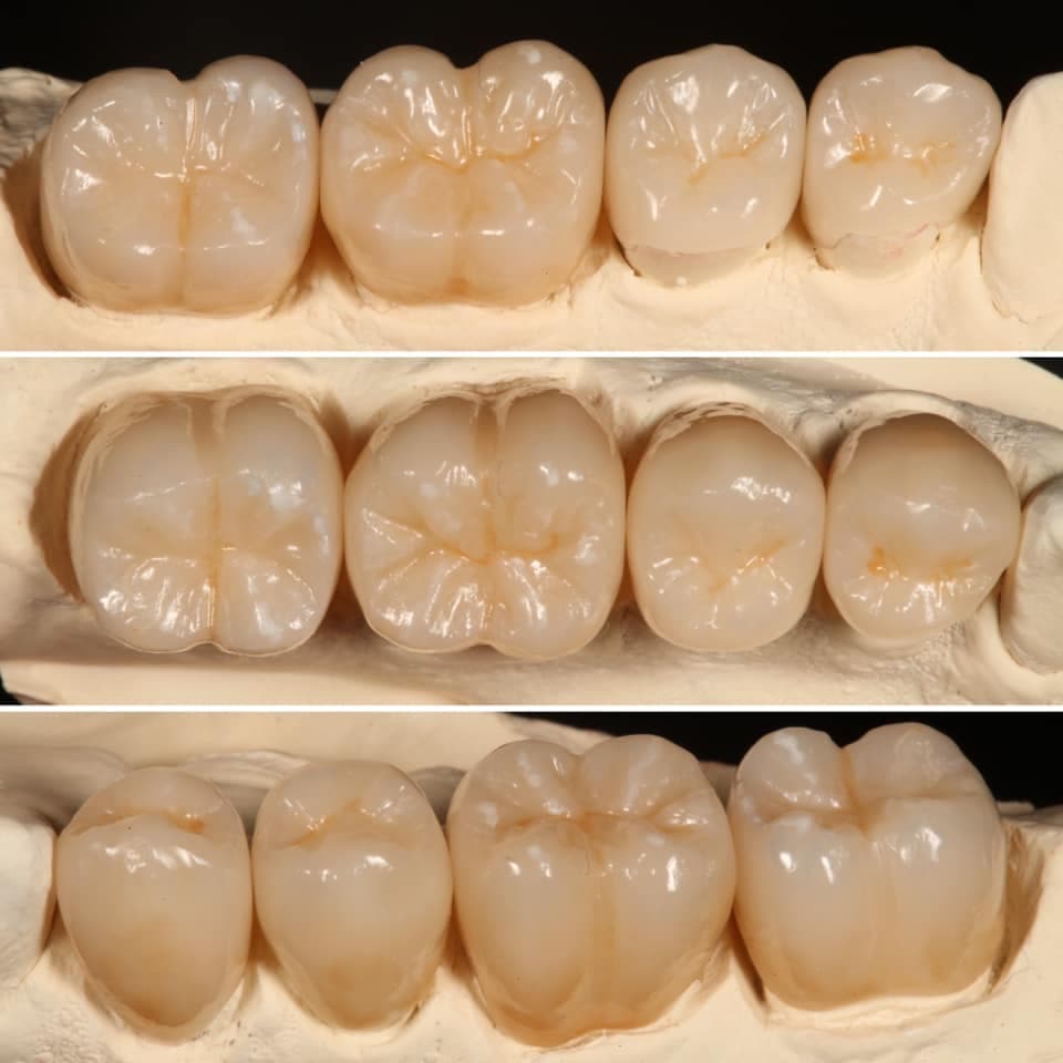 Restoration crafted by Strupp & Brumm in-house dental lab — piece 8