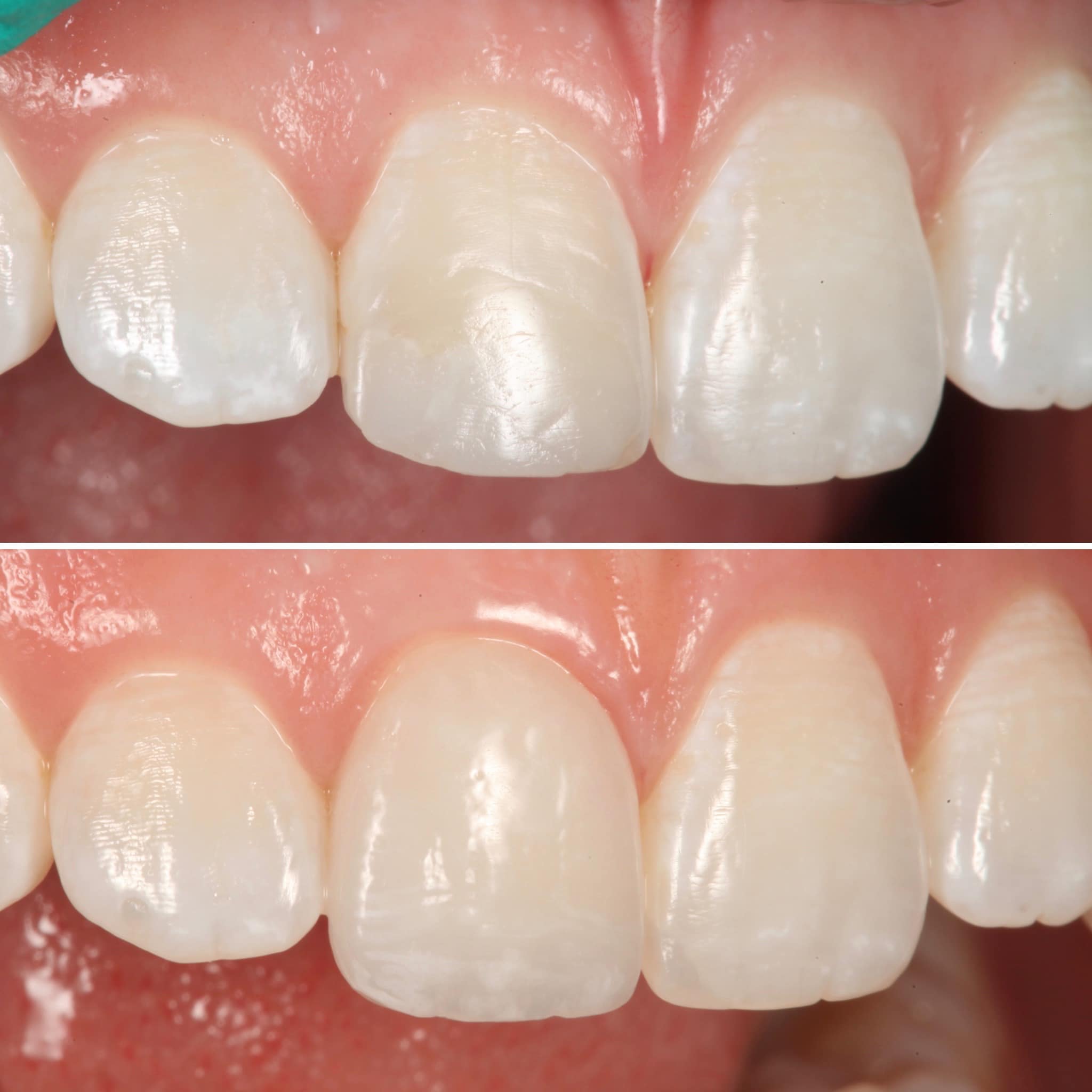 Restoration crafted by Strupp & Brumm in-house dental lab — piece 9