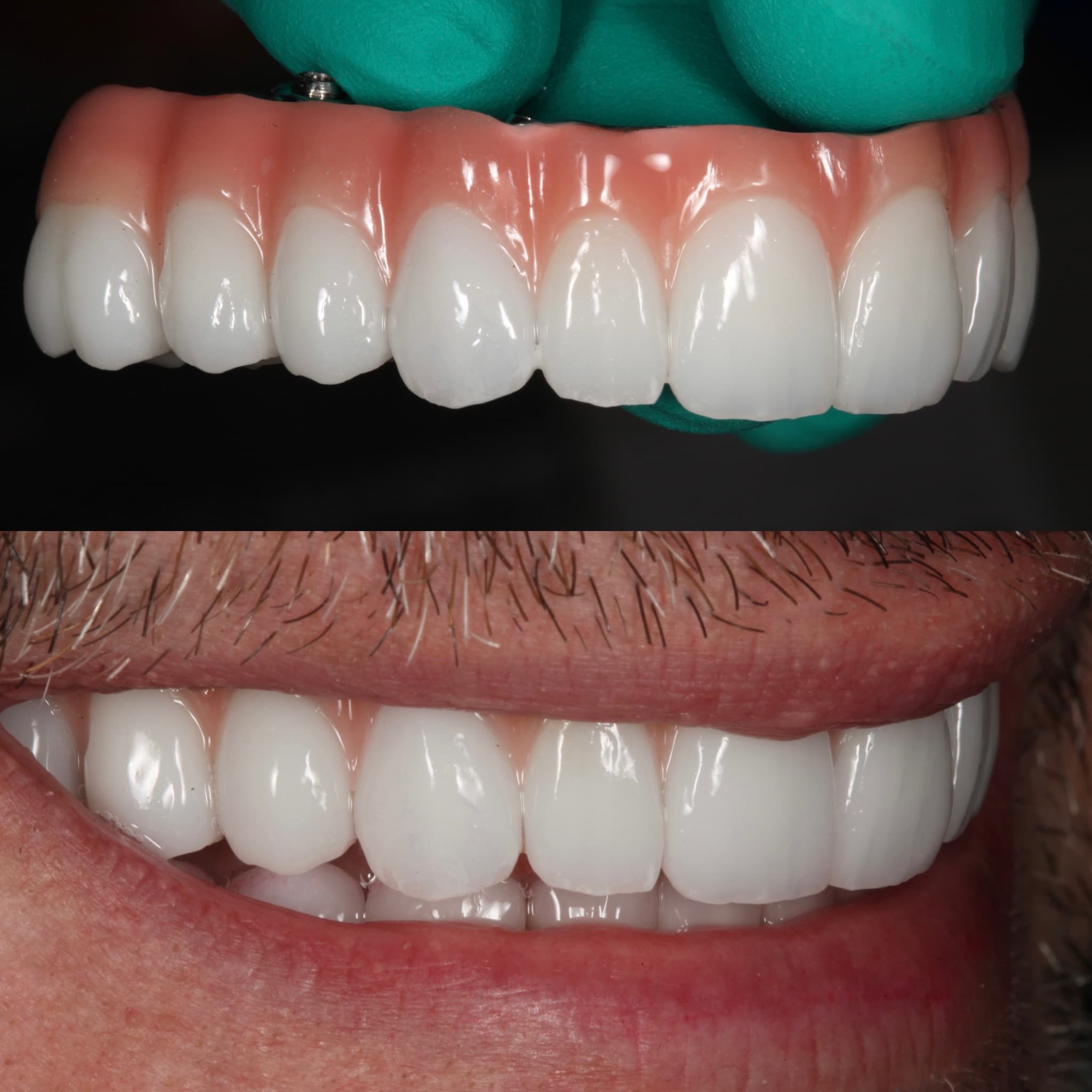 Restoration crafted by Strupp & Brumm in-house dental lab — piece 10