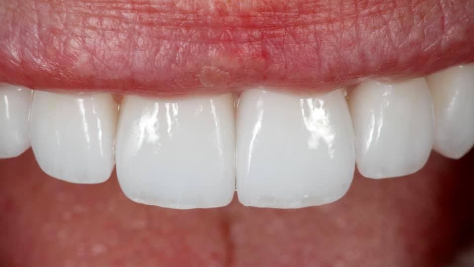 Restoration crafted by Strupp & Brumm in-house dental lab — piece 11