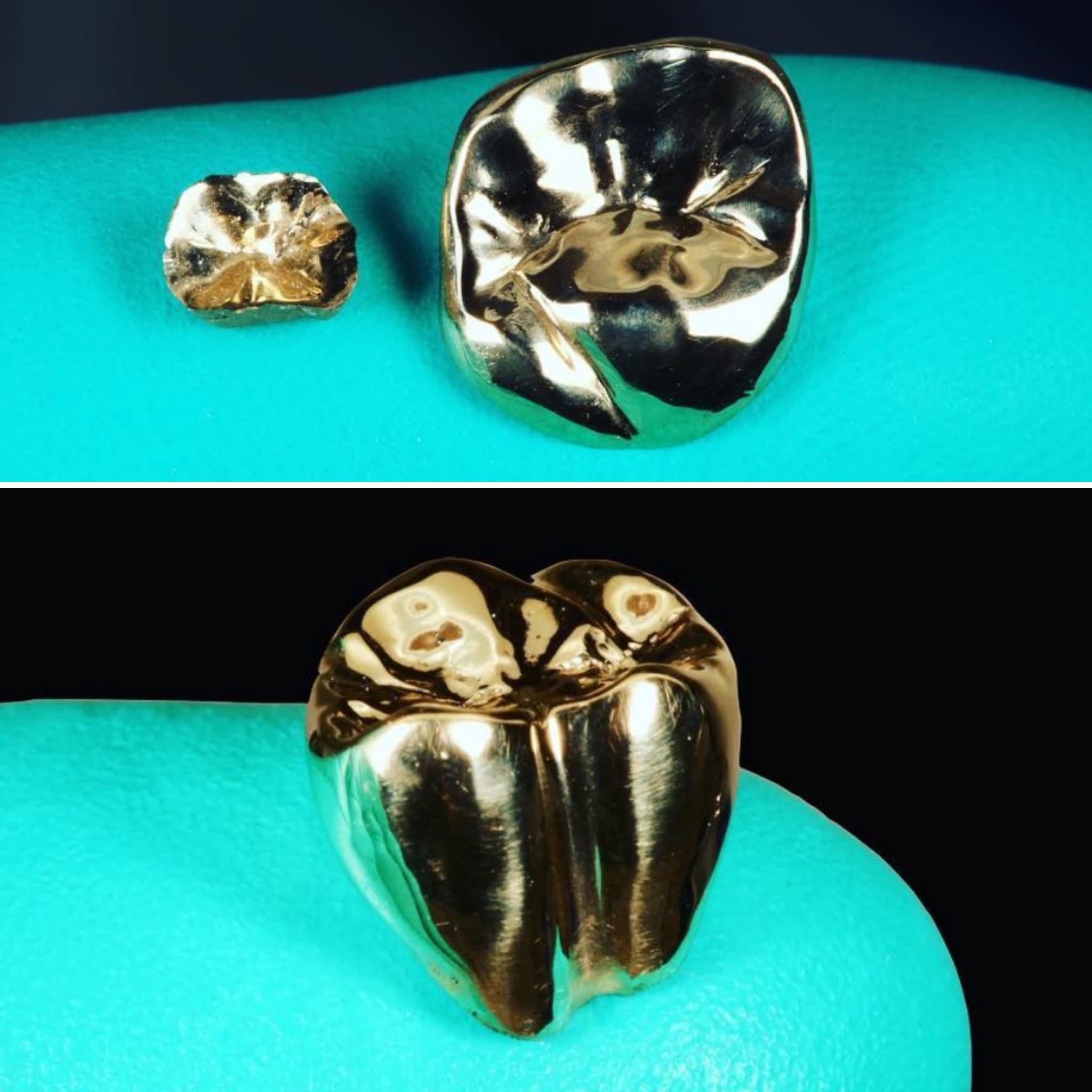 Restoration crafted by Strupp & Brumm in-house dental lab — piece 12