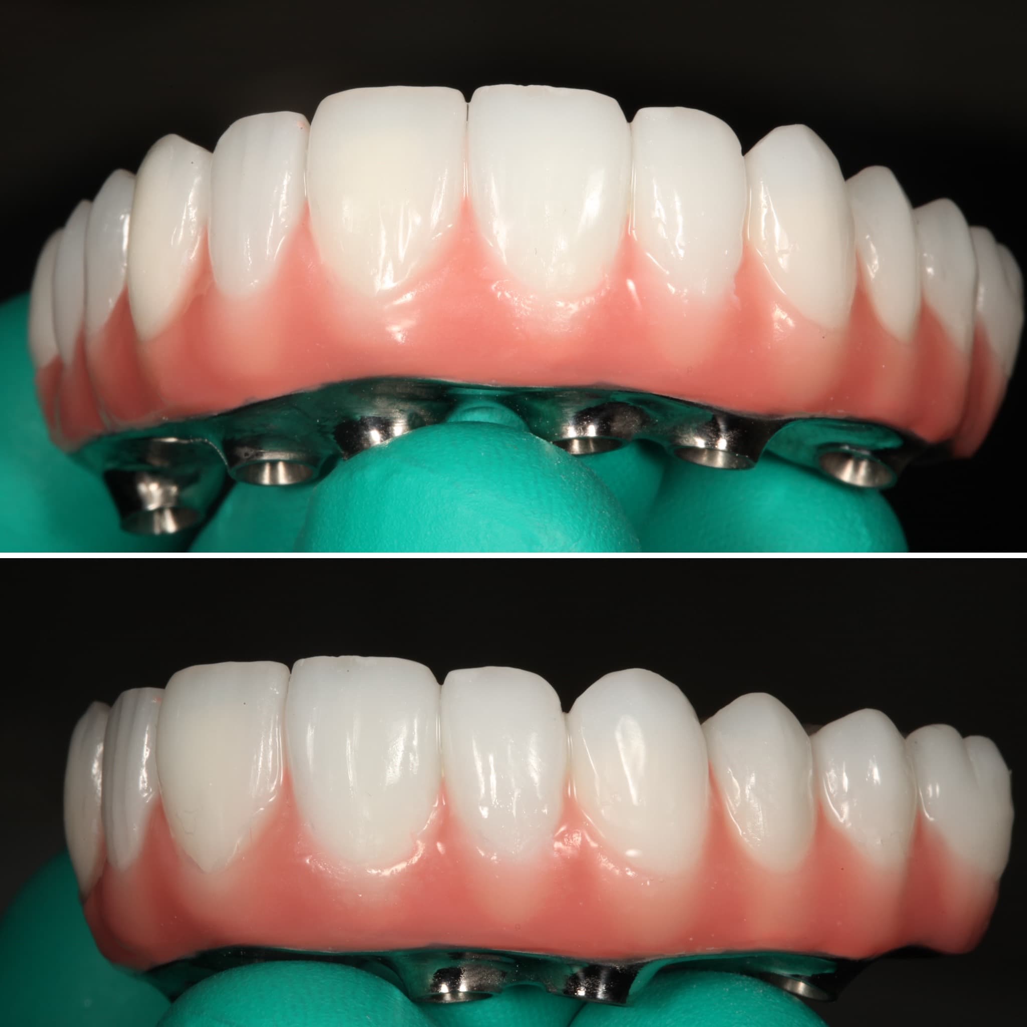 Restoration crafted by Strupp & Brumm in-house dental lab — piece 13