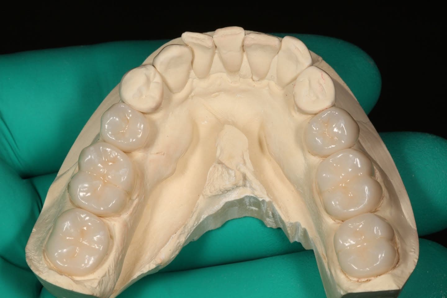 Restoration crafted by Strupp & Brumm in-house dental lab — piece 14