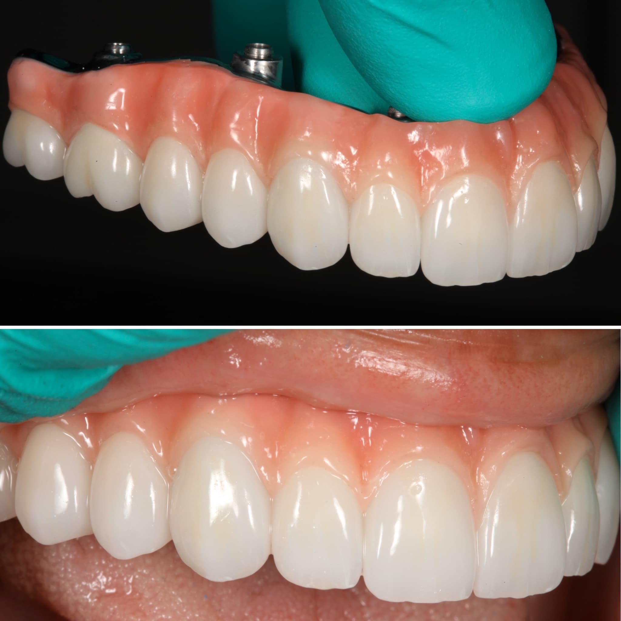 Restoration crafted by Strupp & Brumm in-house dental lab — piece 15