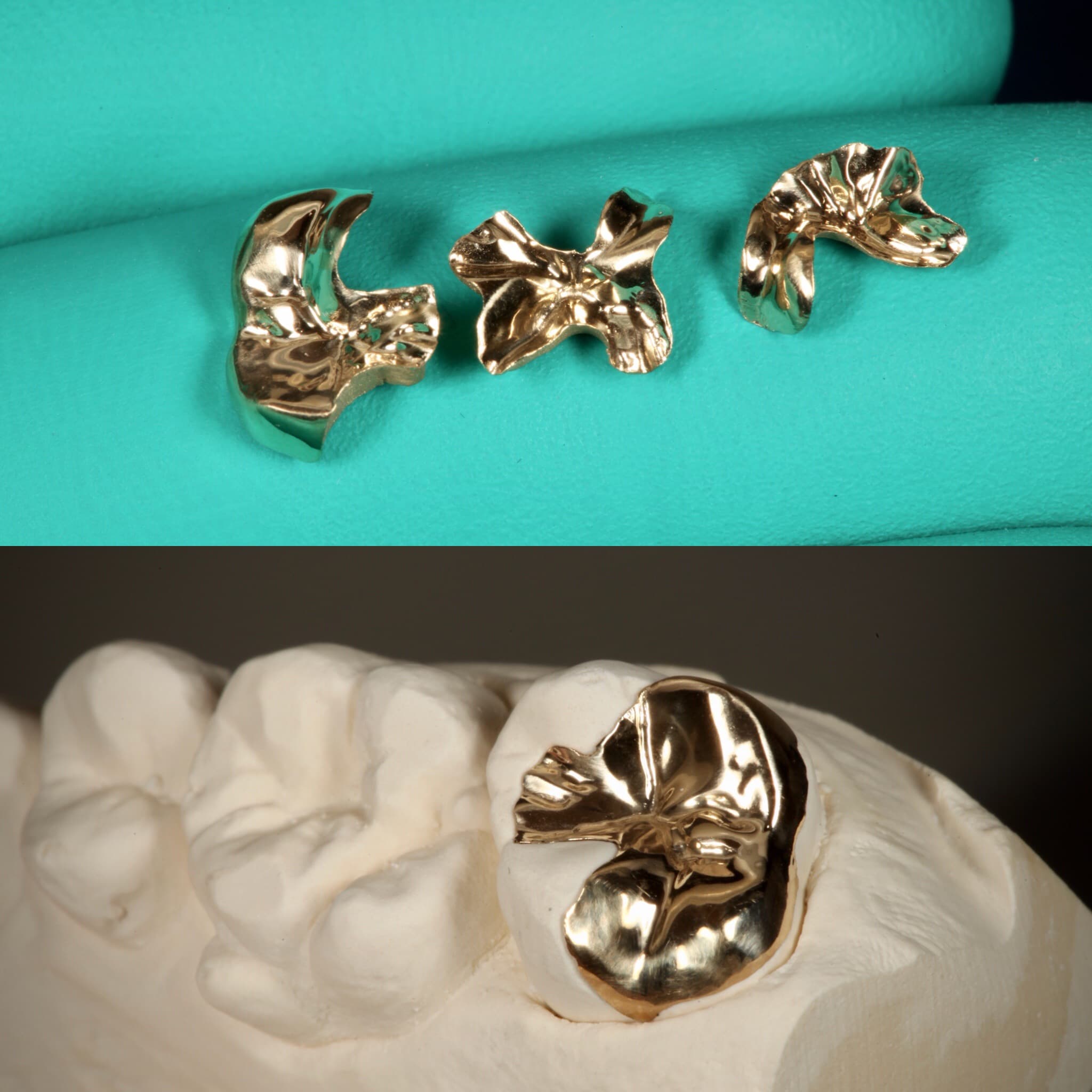 Restoration crafted by Strupp & Brumm in-house dental lab — piece 16