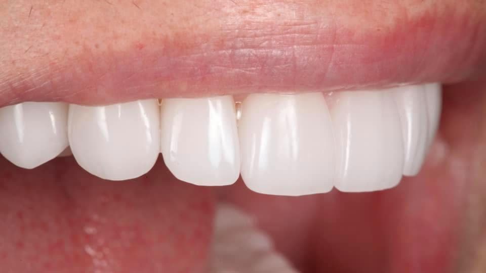 Restoration crafted by Strupp & Brumm in-house dental lab — piece 17