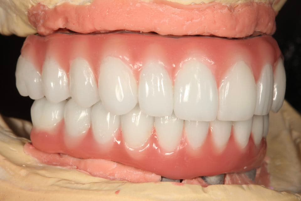 Restoration crafted by Strupp & Brumm in-house dental lab — piece 18