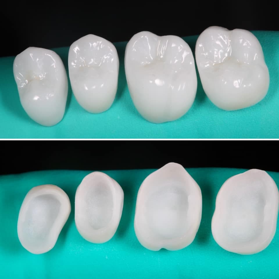 Restoration crafted by Strupp & Brumm in-house dental lab — piece 19