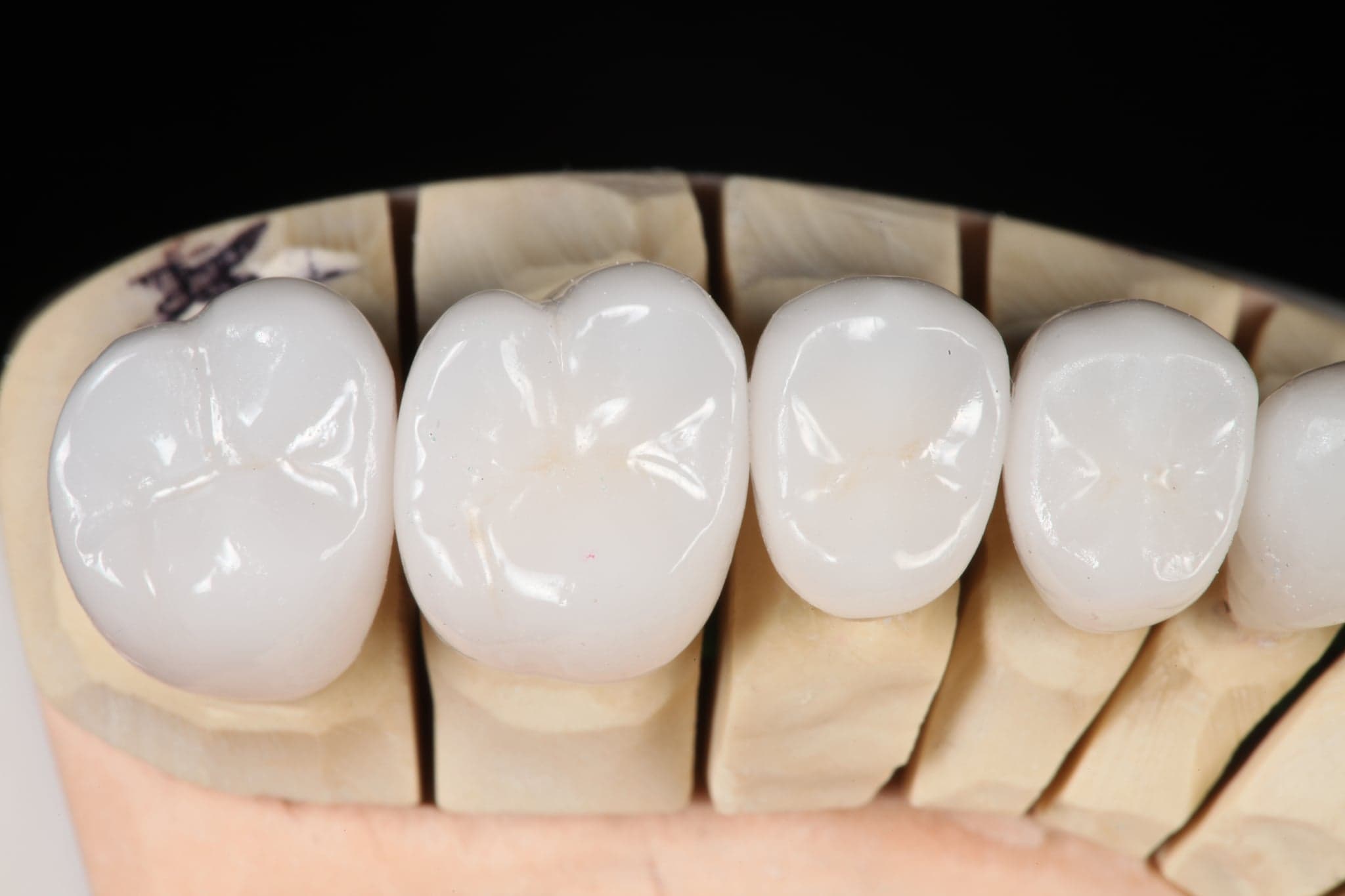 Restoration crafted by Strupp & Brumm in-house dental lab — piece 20