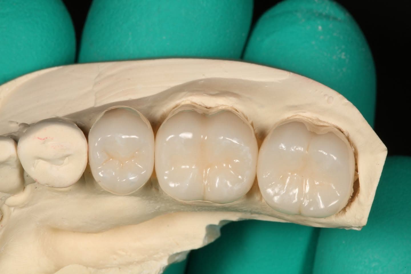 Restoration crafted by Strupp & Brumm in-house dental lab — piece 21