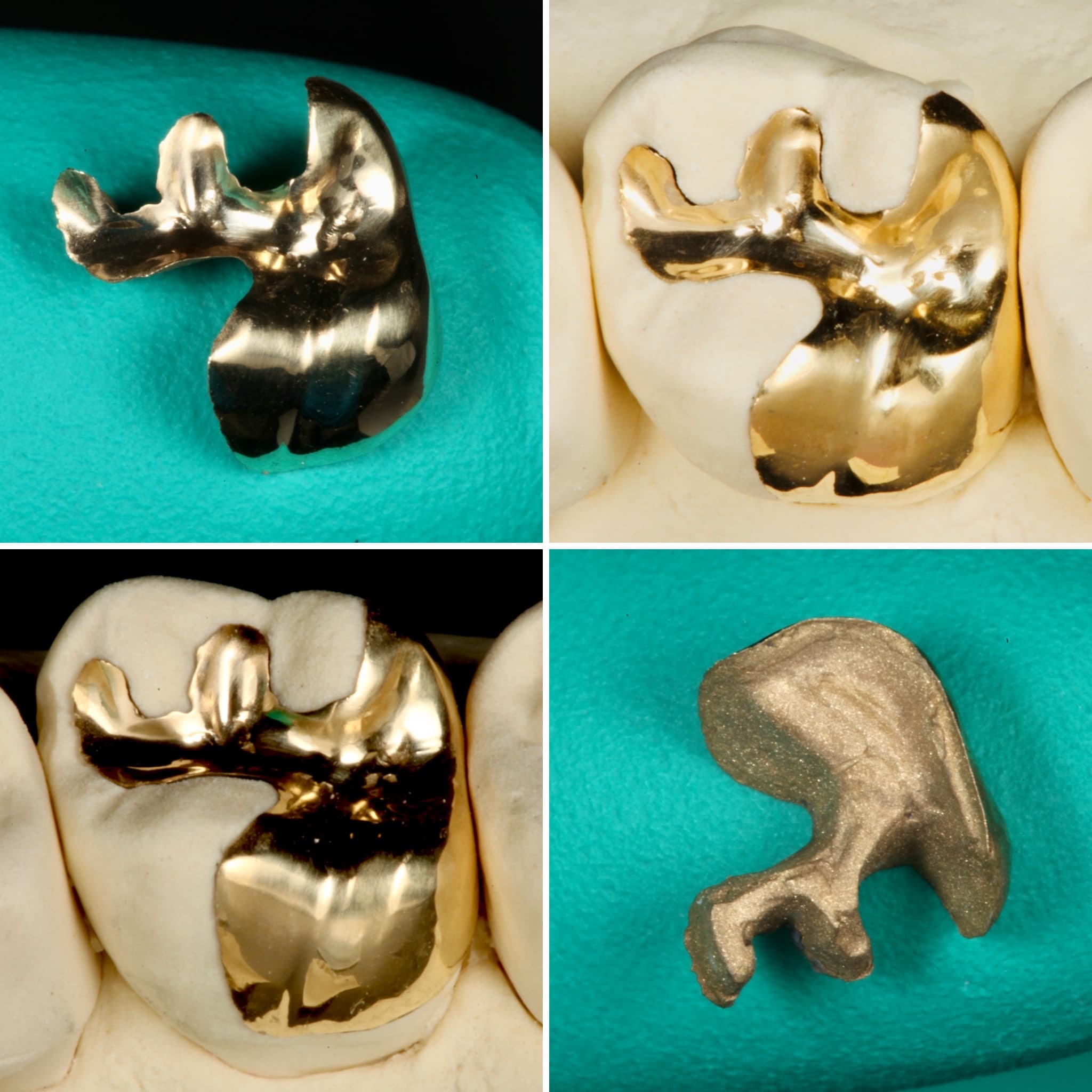 Restoration crafted by Strupp & Brumm in-house dental lab — piece 22