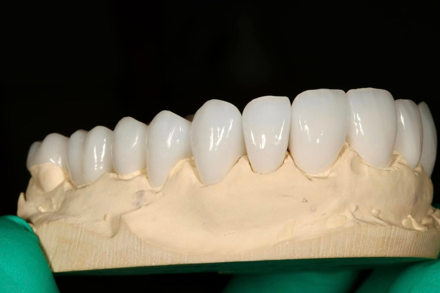 Restoration crafted by Strupp & Brumm in-house dental lab — piece 23