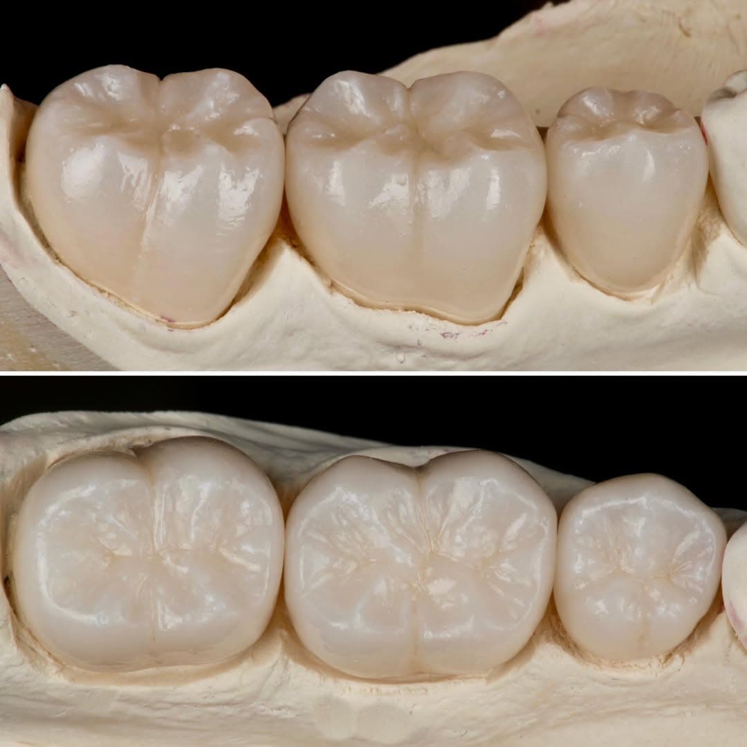 Restoration crafted by Strupp & Brumm in-house dental lab — piece 24