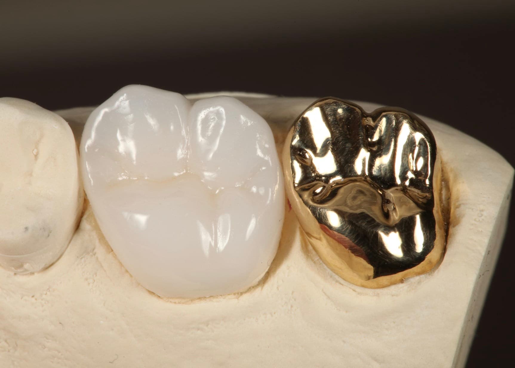 Restoration crafted by Strupp & Brumm in-house dental lab — piece 25