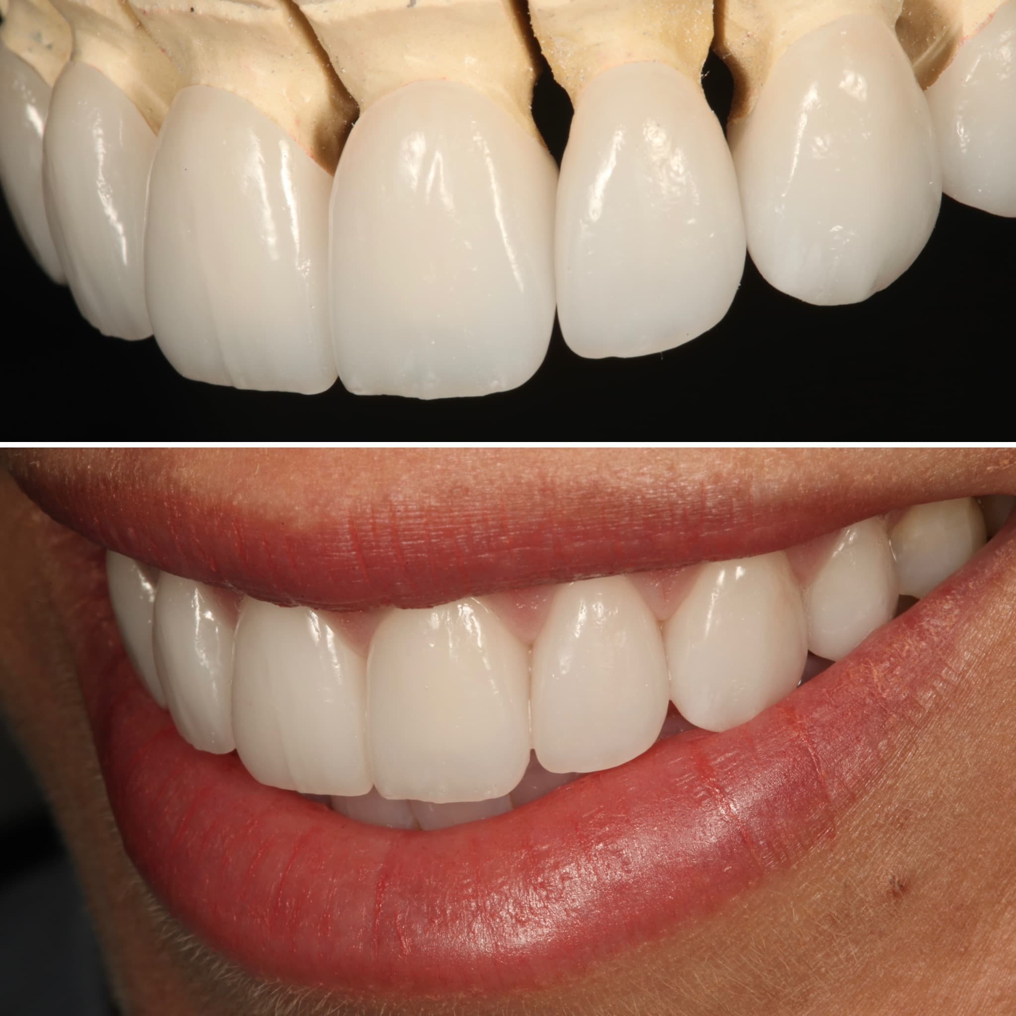 Restoration crafted by Strupp & Brumm in-house dental lab — piece 26