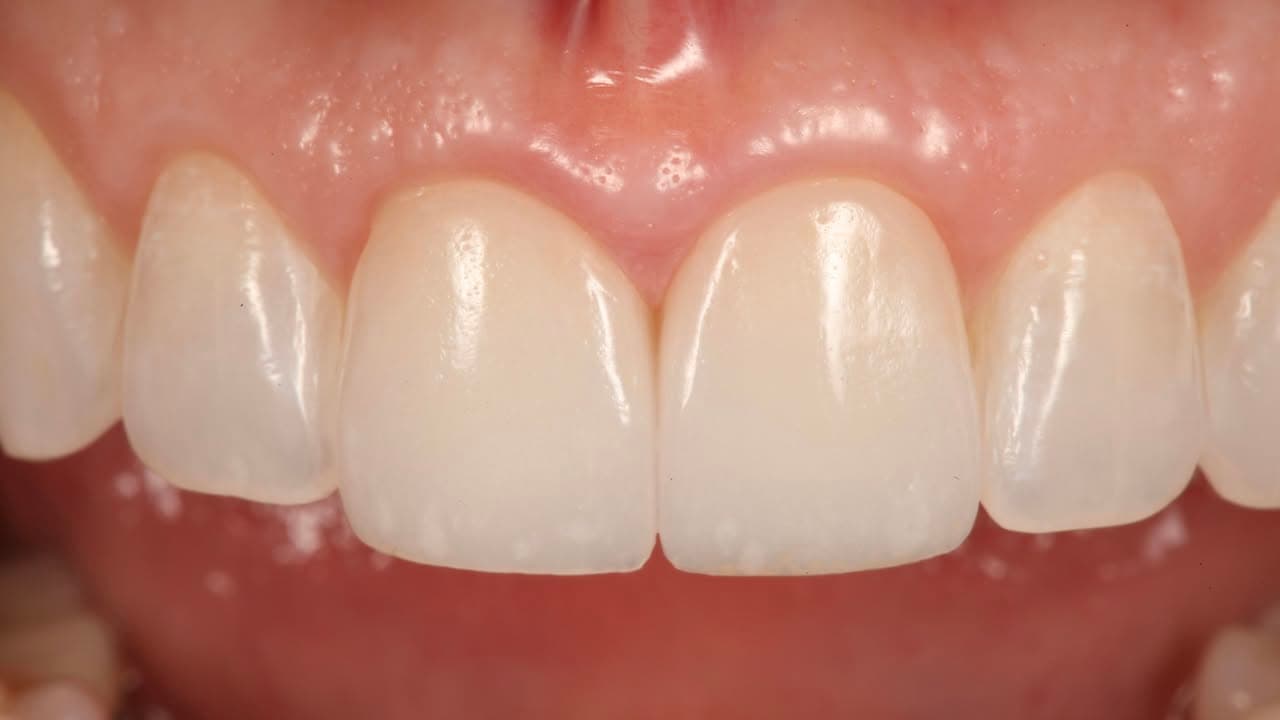 Restoration crafted by Strupp & Brumm in-house dental lab — piece 27