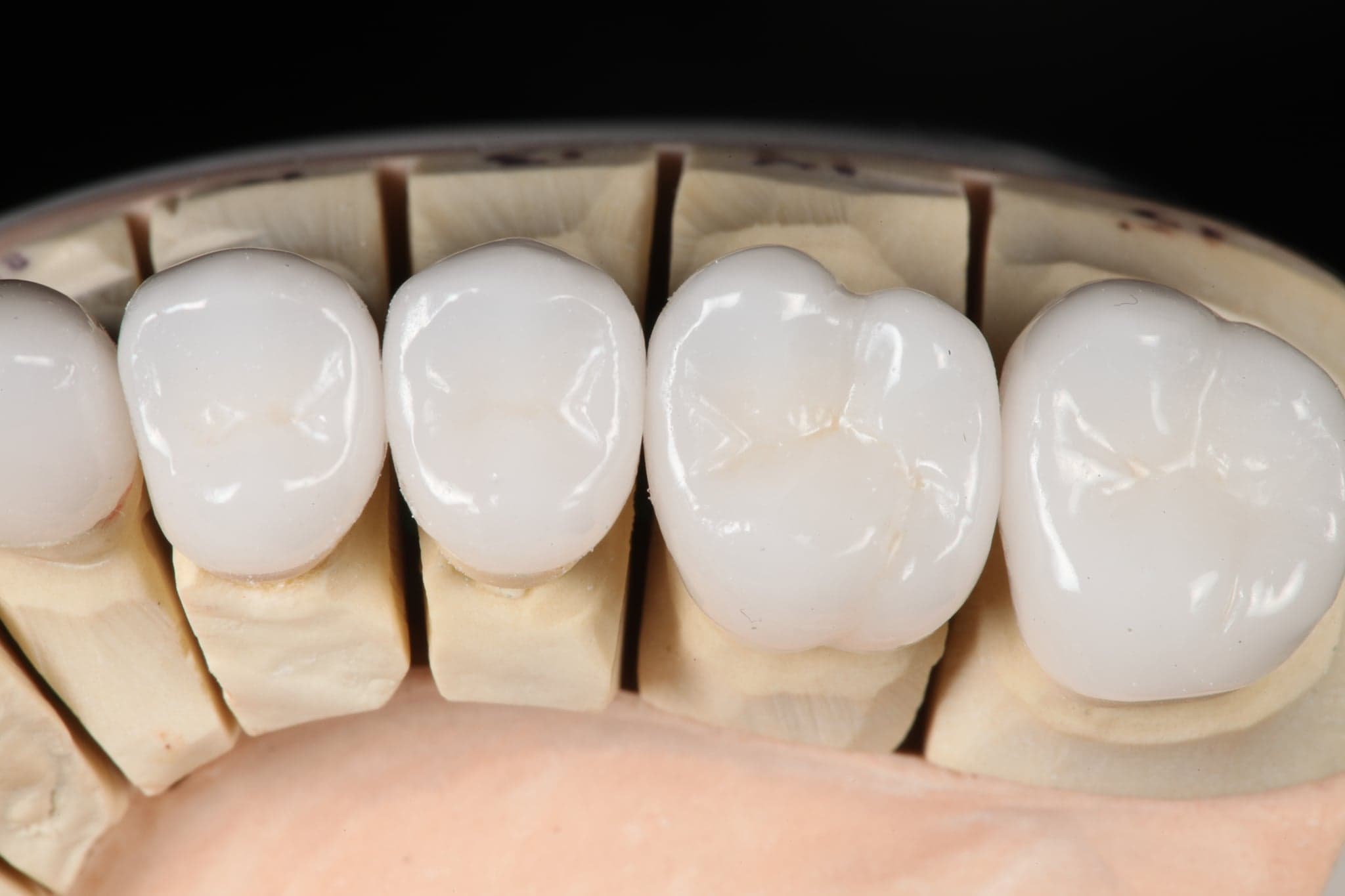 Restoration crafted by Strupp & Brumm in-house dental lab — piece 28