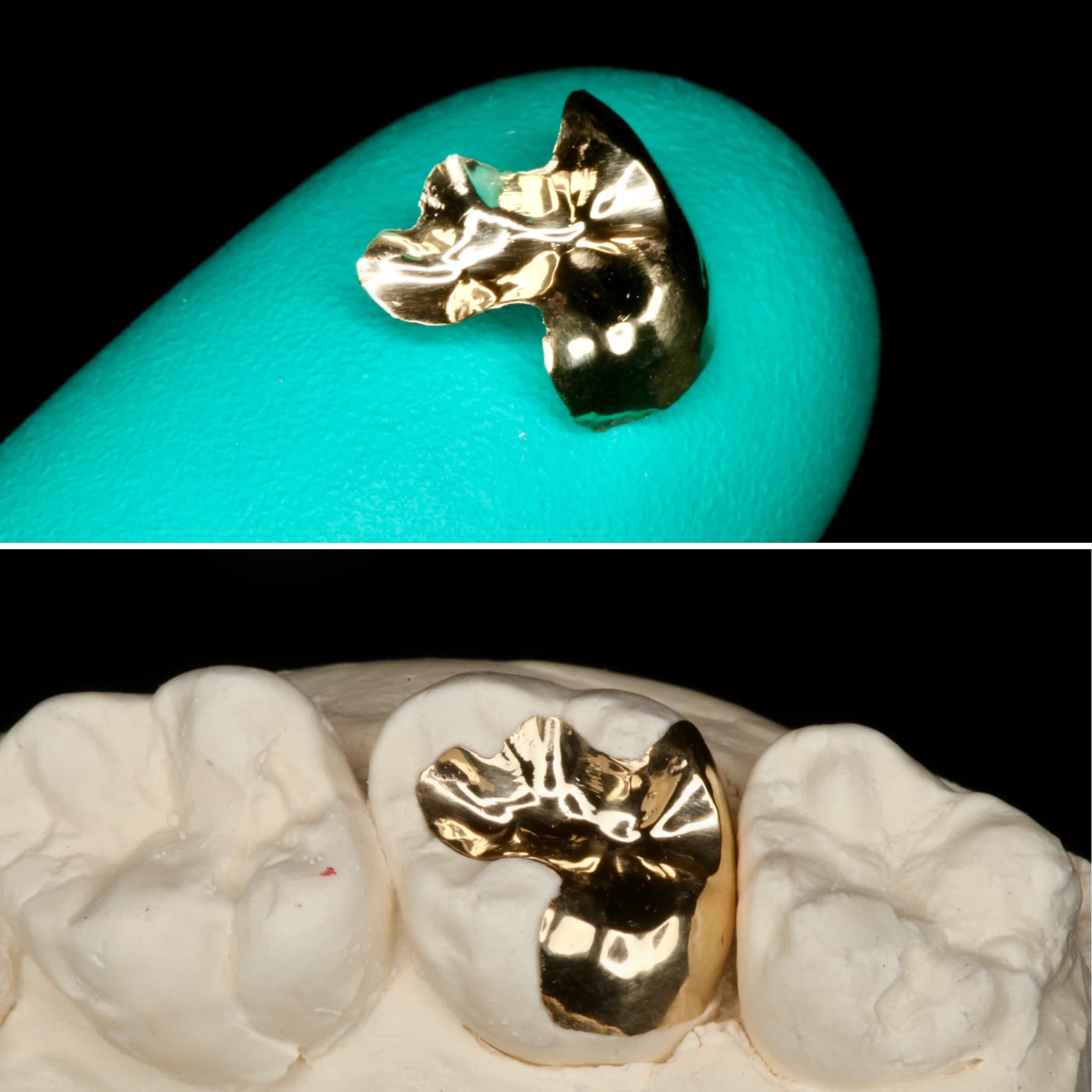Restoration crafted by Strupp & Brumm in-house dental lab — piece 30