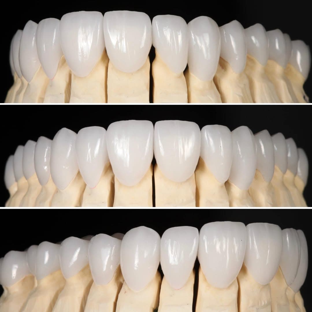 Restoration crafted by Strupp & Brumm in-house dental lab — piece 31