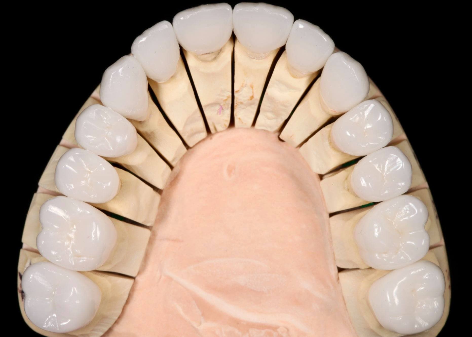 Restoration crafted by Strupp & Brumm in-house dental lab — piece 32
