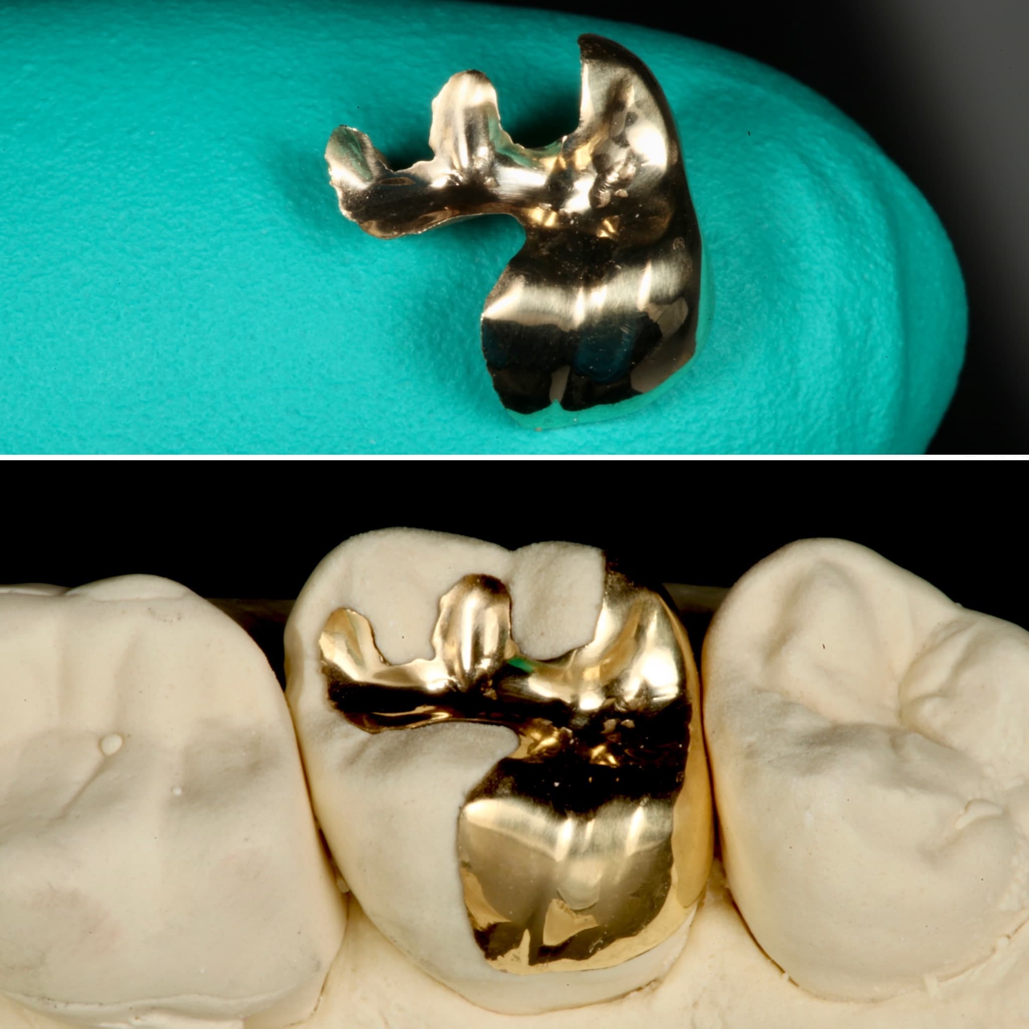 Restoration crafted by Strupp & Brumm in-house dental lab — piece 33