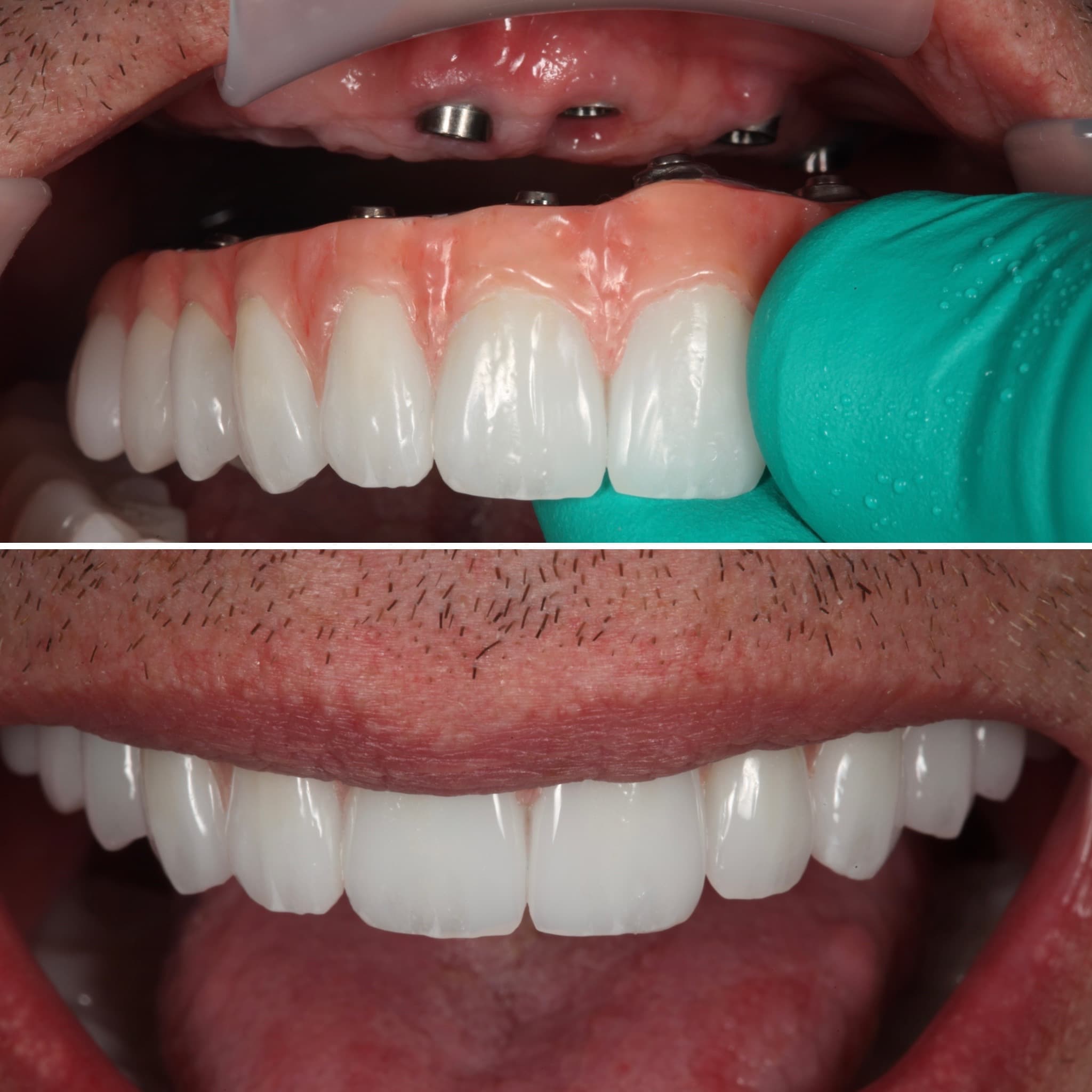 Restoration crafted by Strupp & Brumm in-house dental lab — piece 34