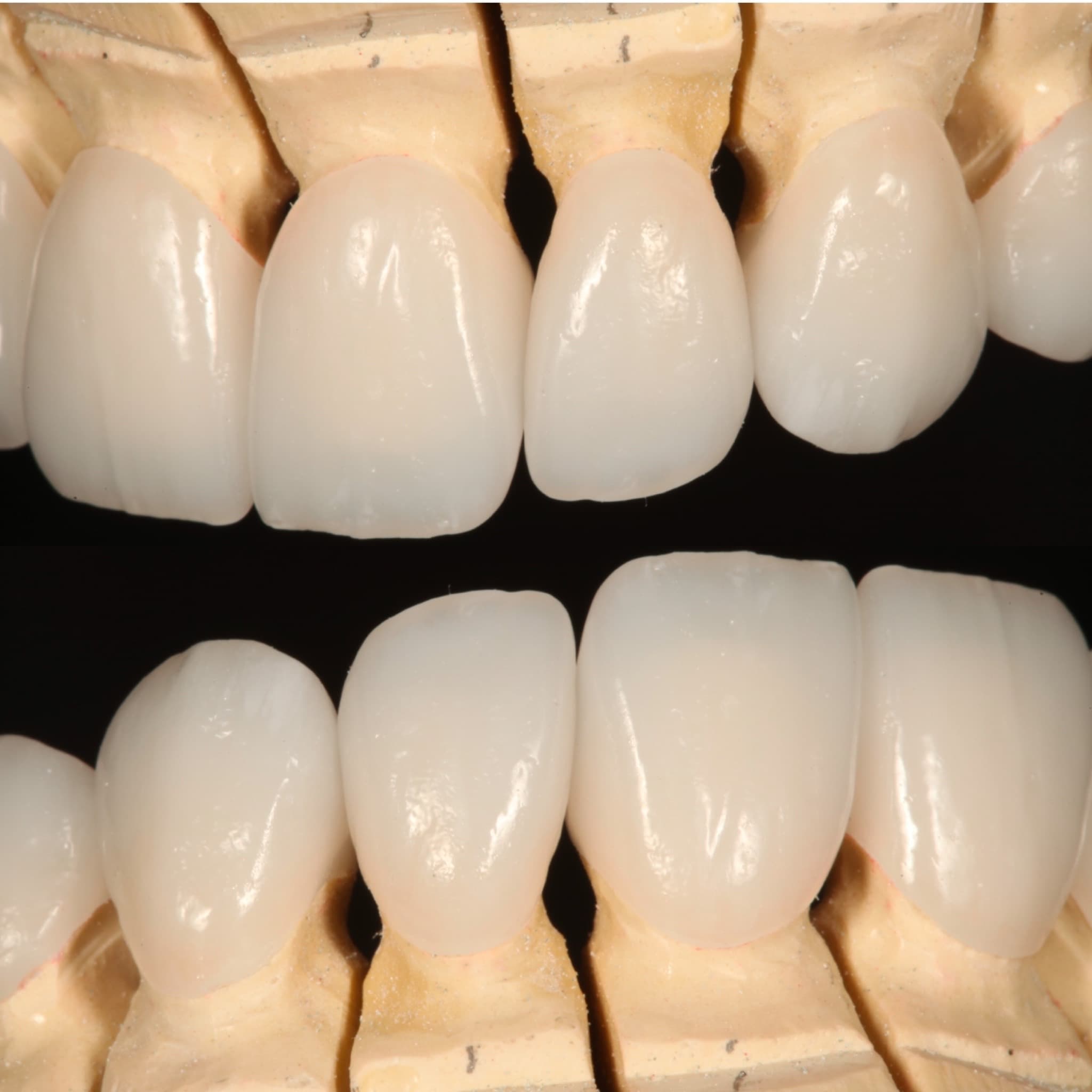Restoration crafted by Strupp & Brumm in-house dental lab — piece 35