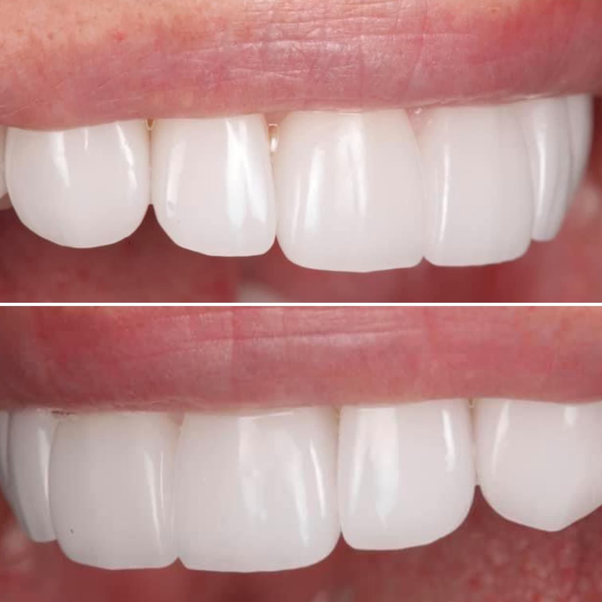 Restoration crafted by Strupp & Brumm in-house dental lab — piece 36
