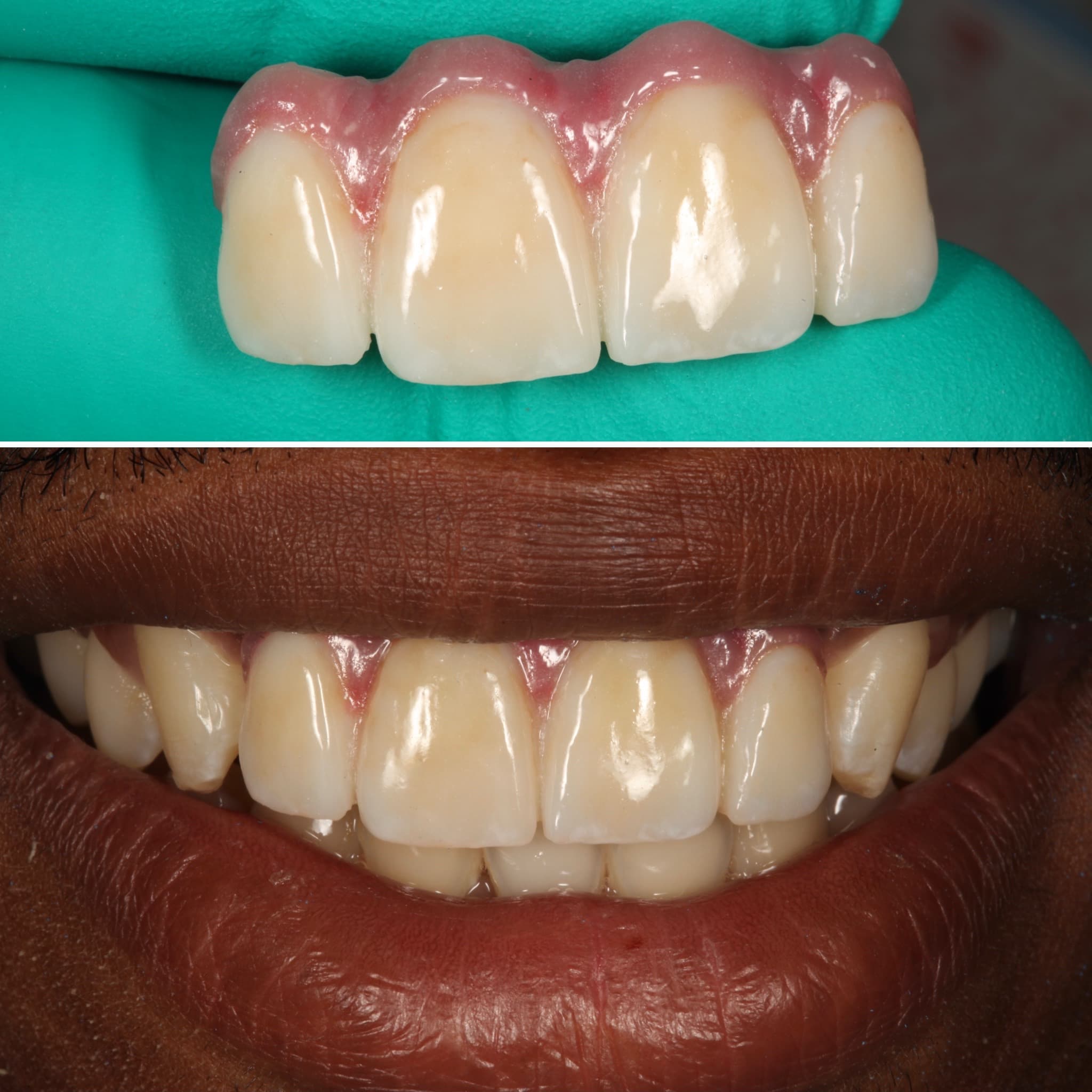 Restoration crafted by Strupp & Brumm in-house dental lab — piece 37