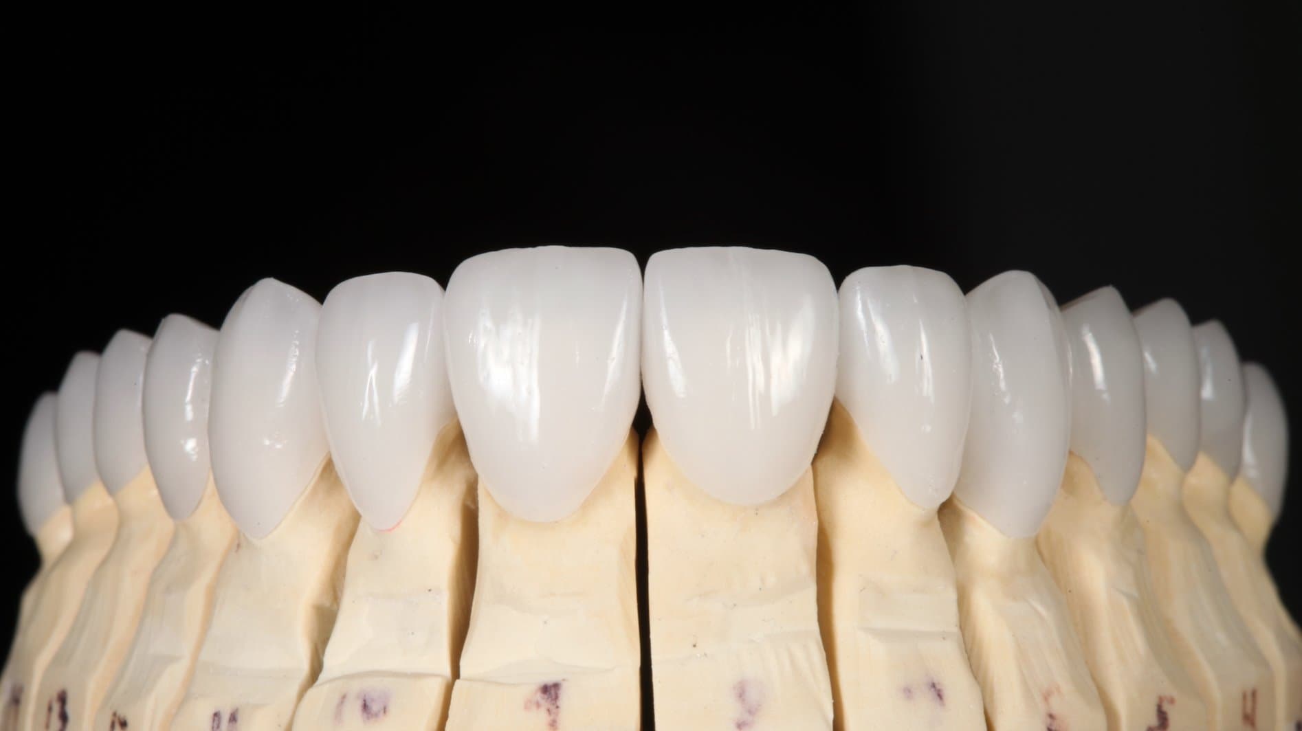 Restoration crafted by Strupp & Brumm in-house dental lab — piece 38