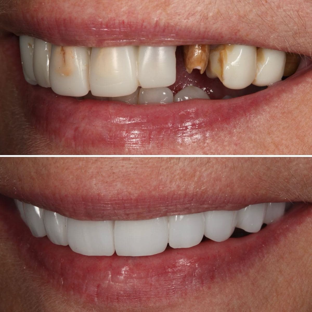 Restoration crafted by Strupp & Brumm in-house dental lab — piece 39