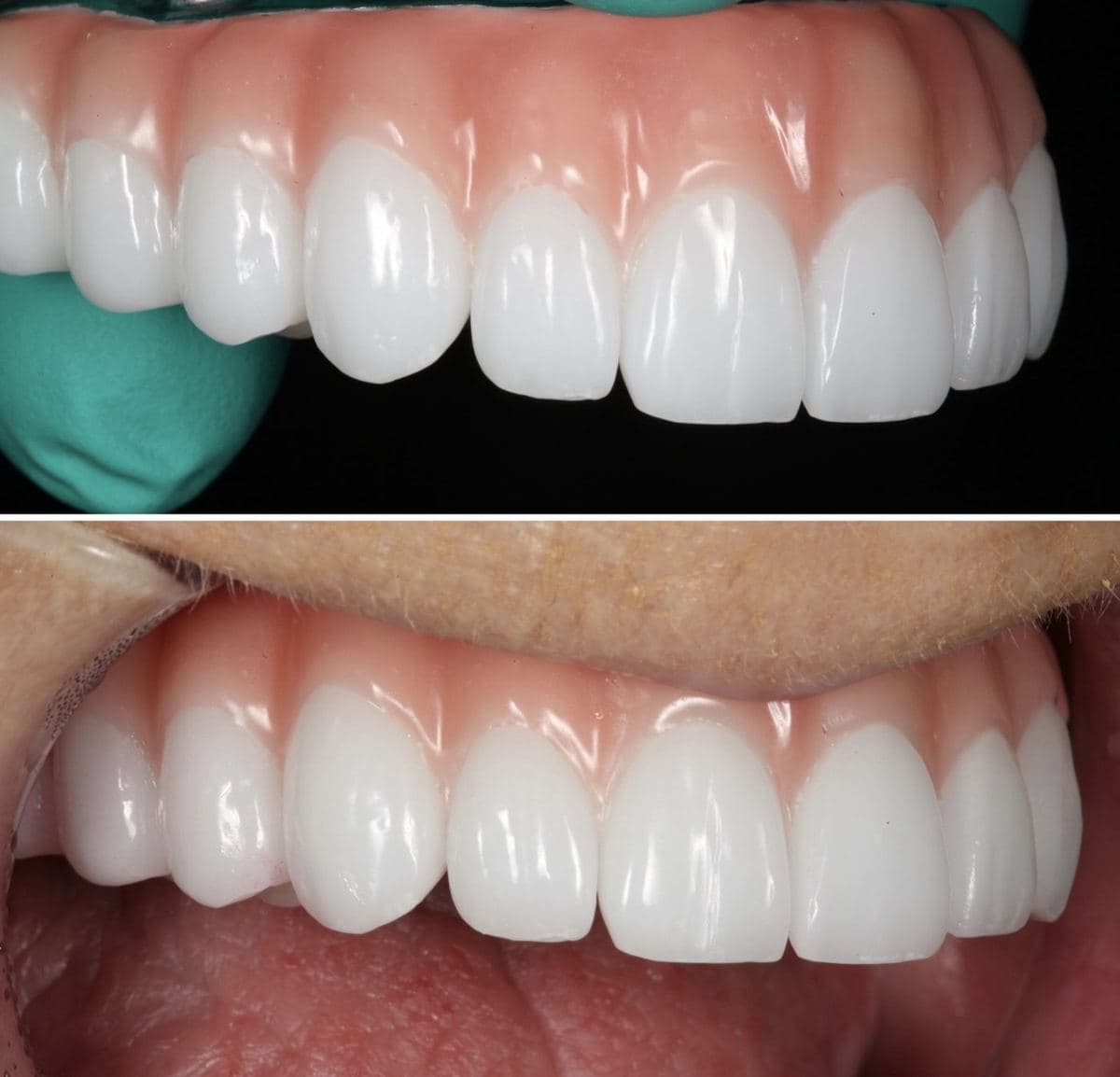 Restoration crafted by Strupp & Brumm in-house dental lab — piece 40