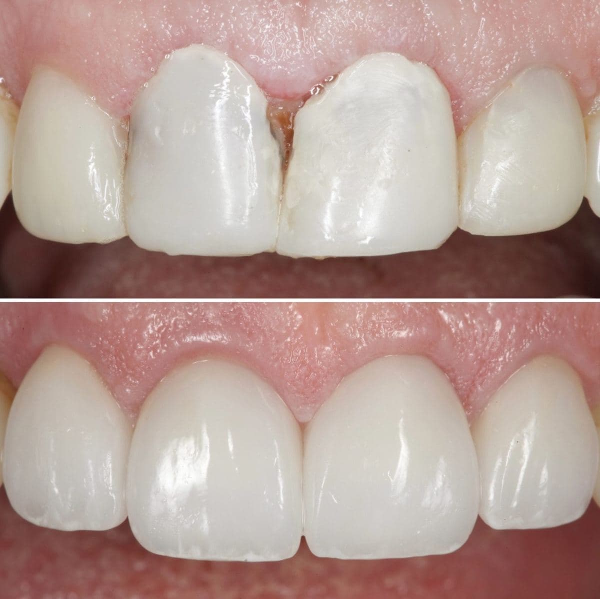 Restoration crafted by Strupp & Brumm in-house dental lab — piece 41