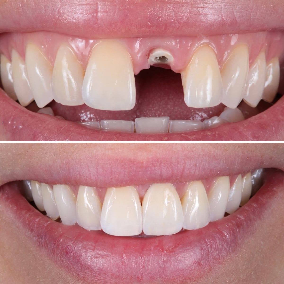 Restoration crafted by Strupp & Brumm in-house dental lab — piece 42