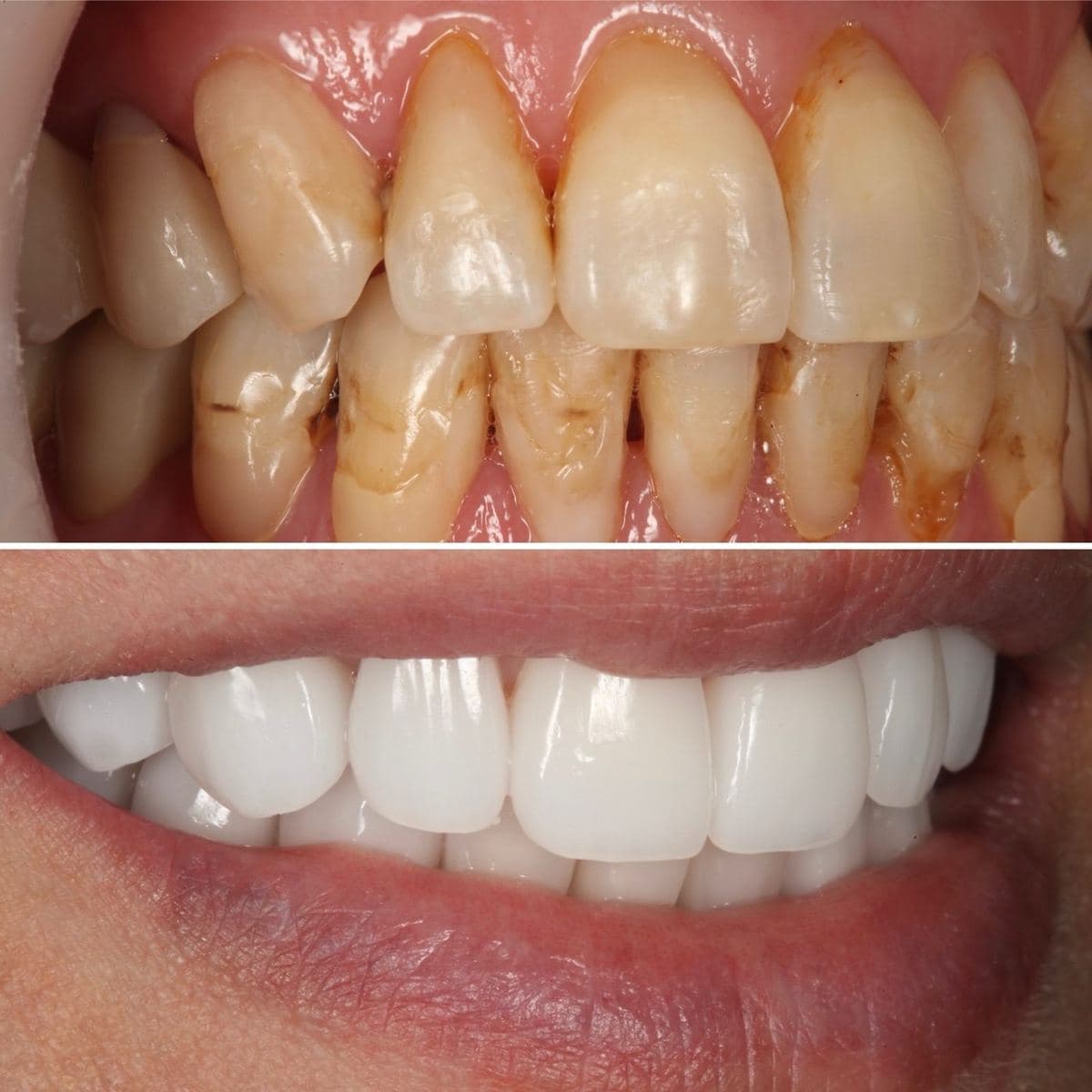 Restoration crafted by Strupp & Brumm in-house dental lab — piece 43