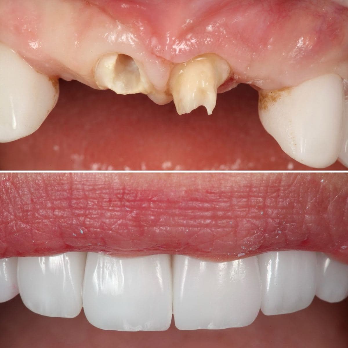 Restoration crafted by Strupp & Brumm in-house dental lab — piece 44