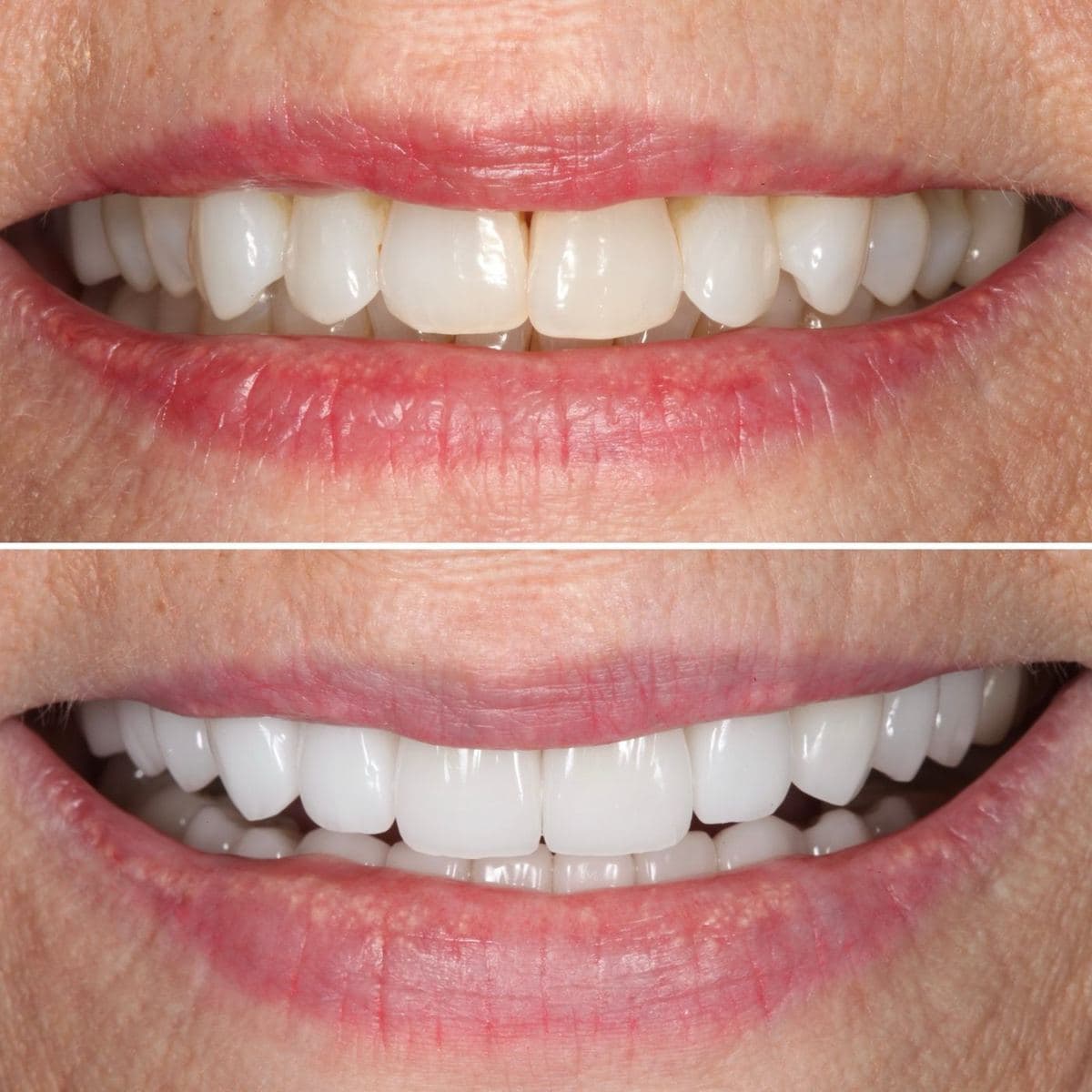 Restoration crafted by Strupp & Brumm in-house dental lab — piece 45