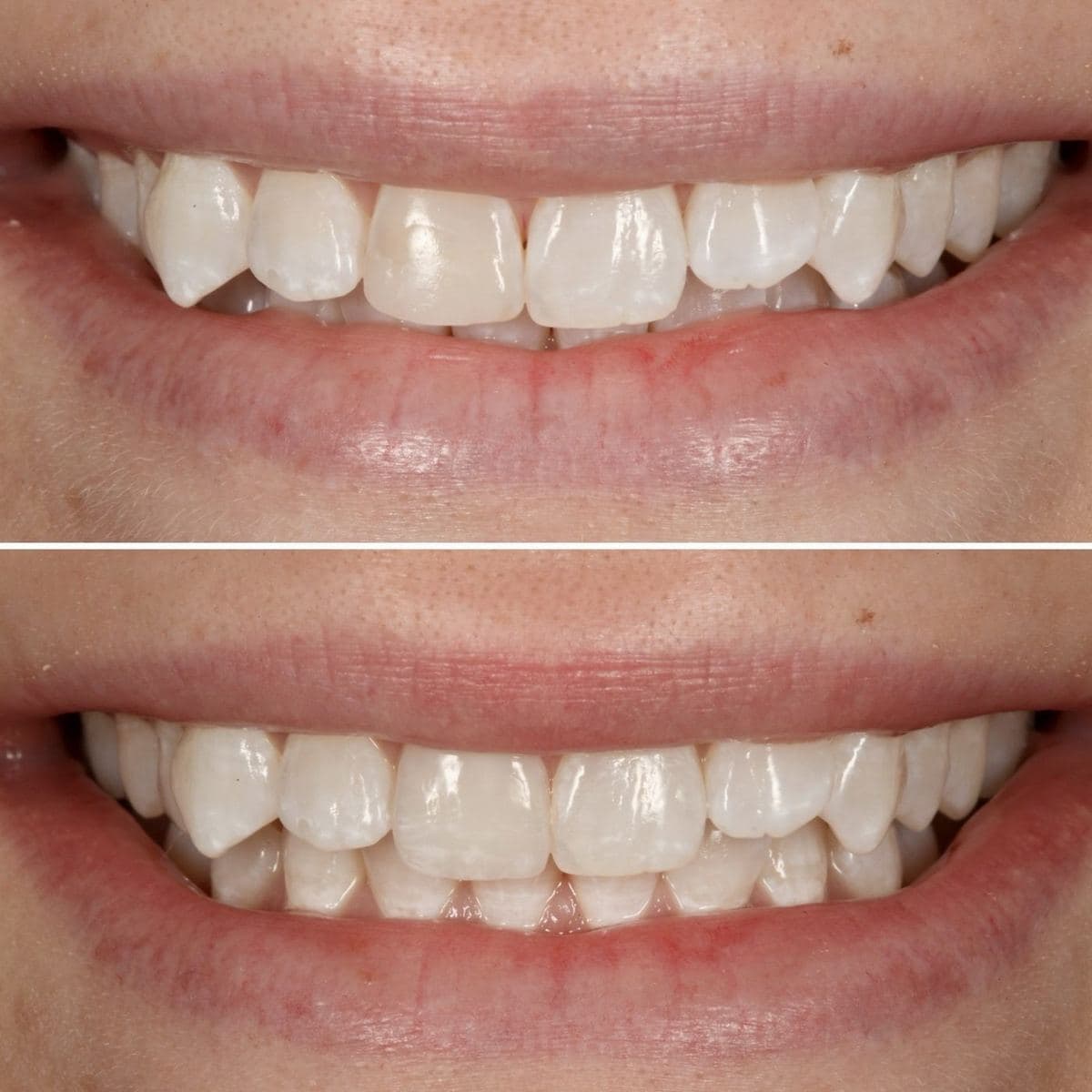 Restoration crafted by Strupp & Brumm in-house dental lab — piece 46
