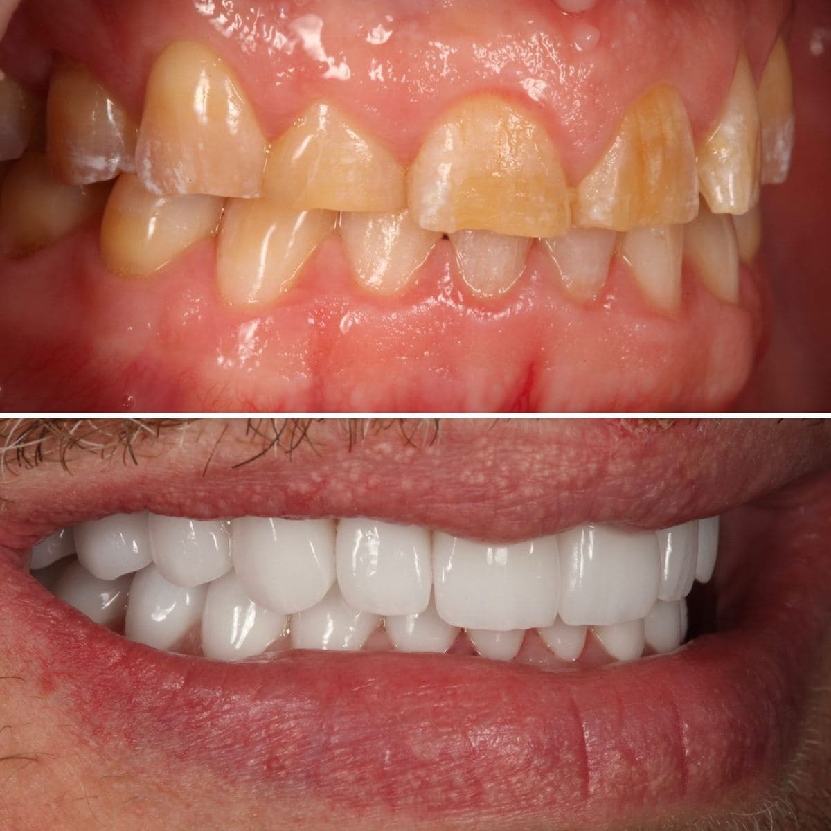 Restoration crafted by Strupp & Brumm in-house dental lab — piece 47