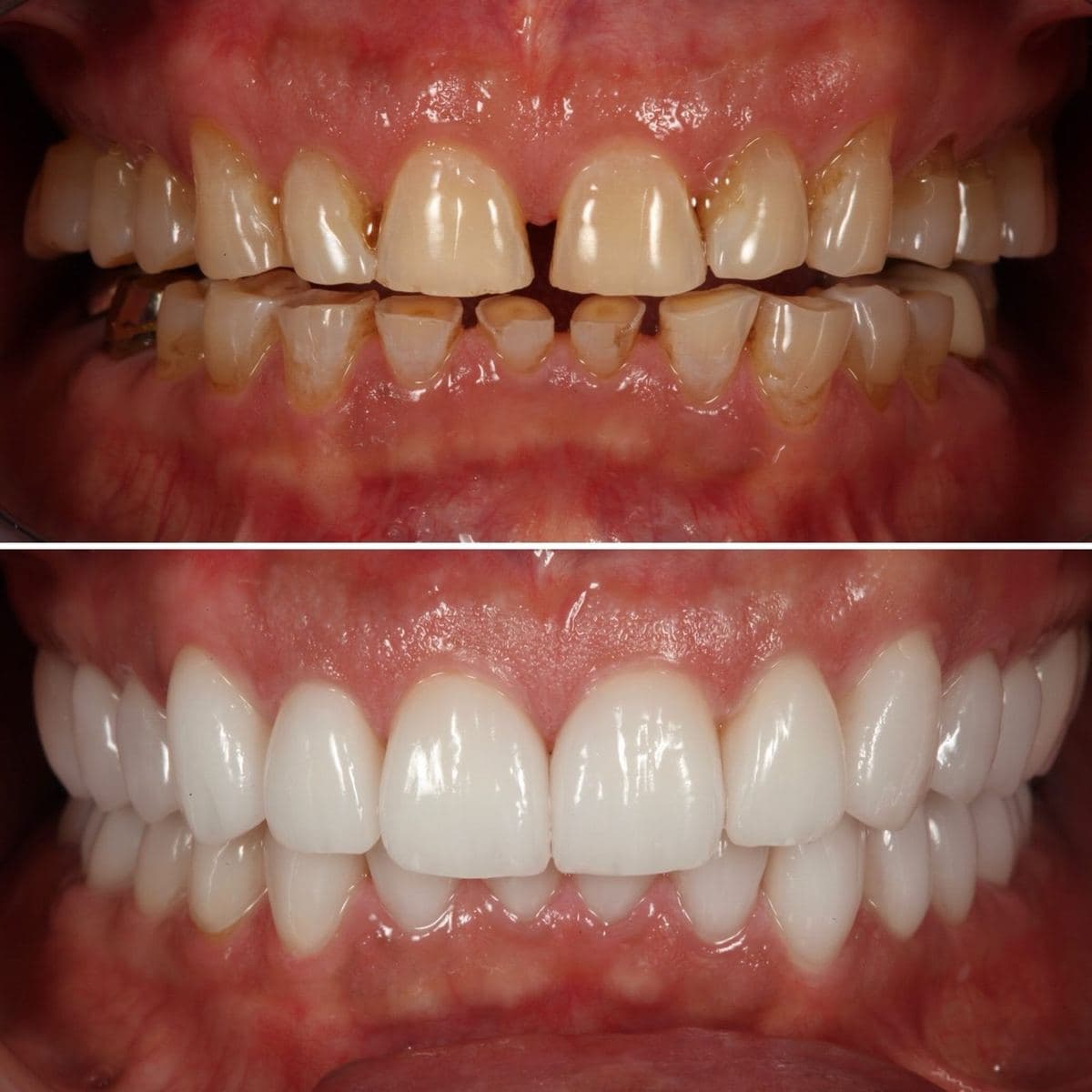Restoration crafted by Strupp & Brumm in-house dental lab — piece 48