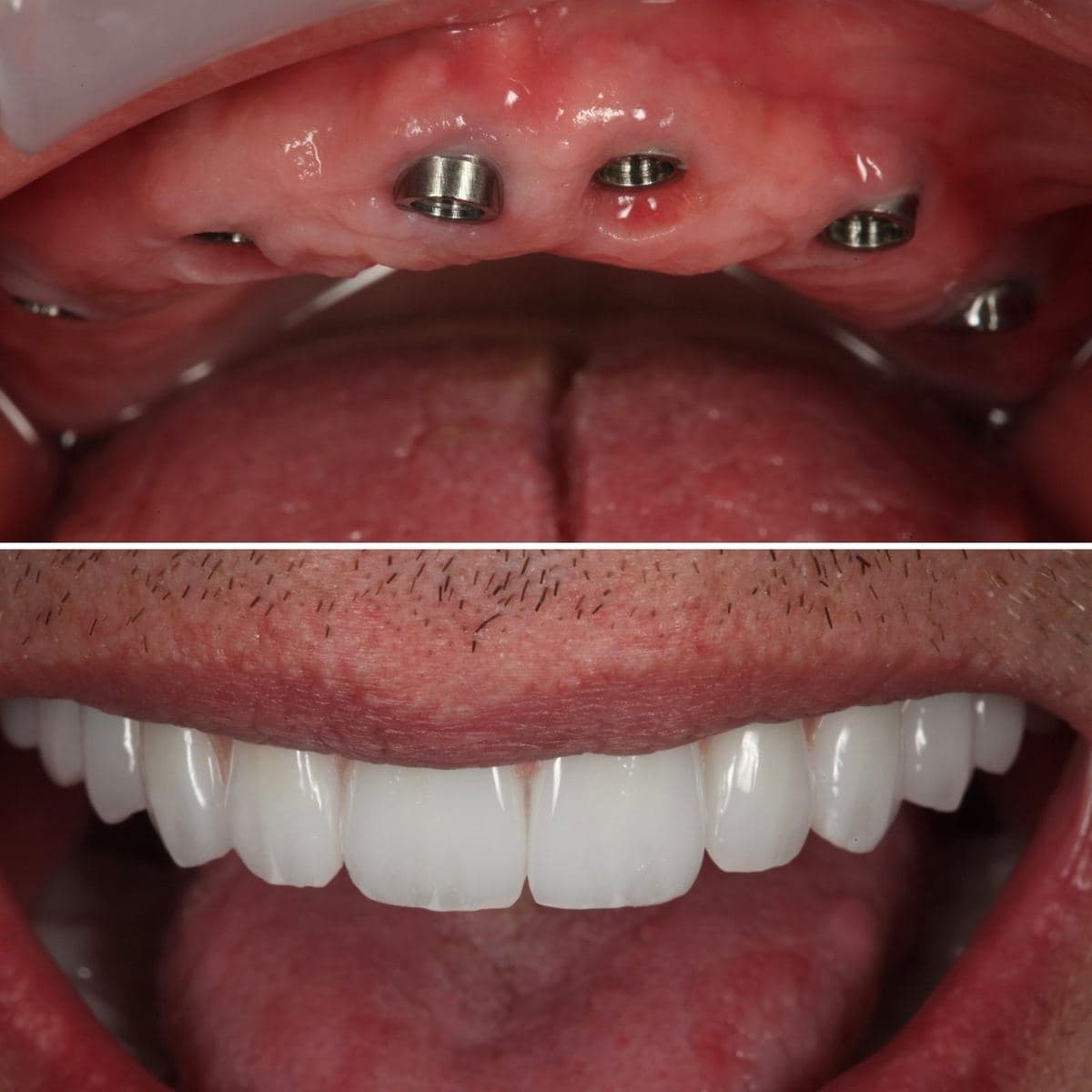 Restoration crafted by Strupp & Brumm in-house dental lab — piece 49