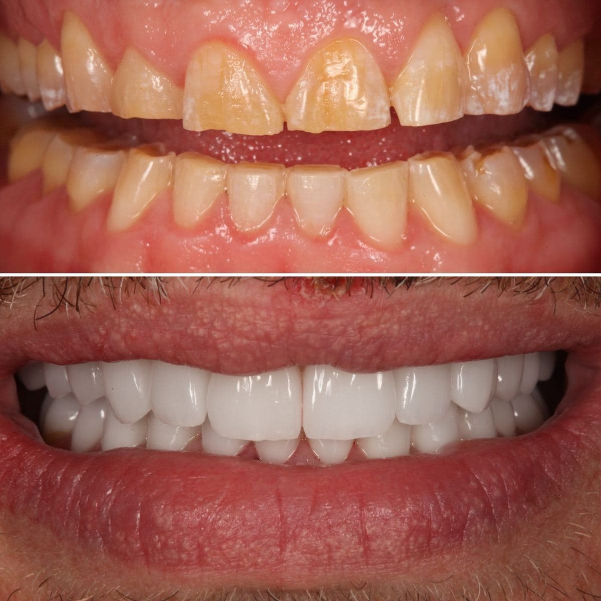 Restoration crafted by Strupp & Brumm in-house dental lab — piece 50